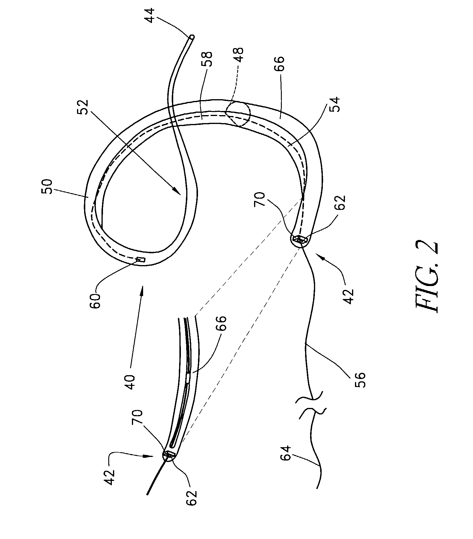 Medical system and method for remodeling an extravascular tissue structure