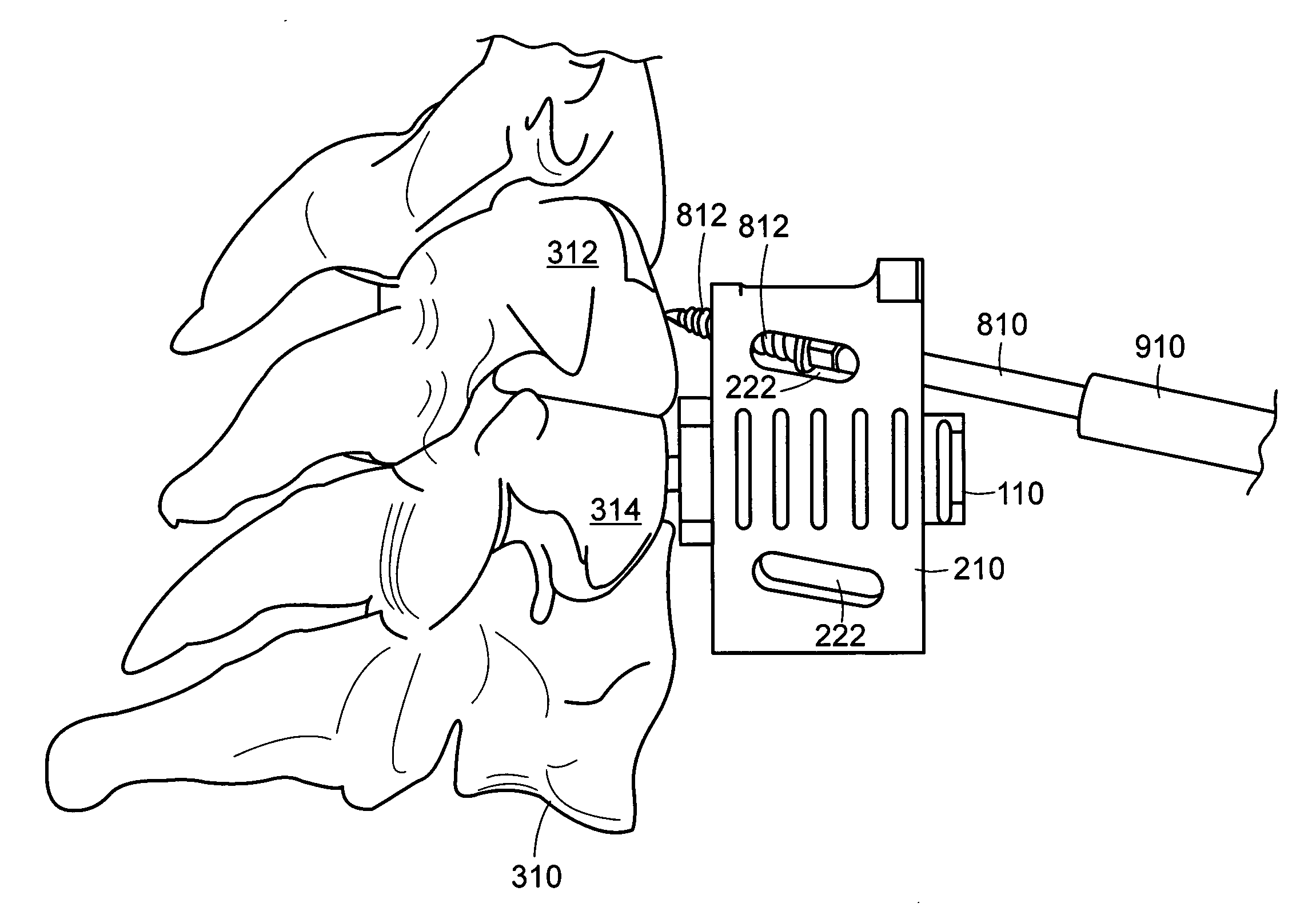 Instrument and method for the insertion and alignment of an intervertebral implant