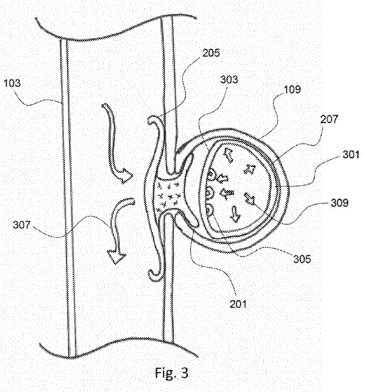 Pulmonary arterial compliance enhancement and control device