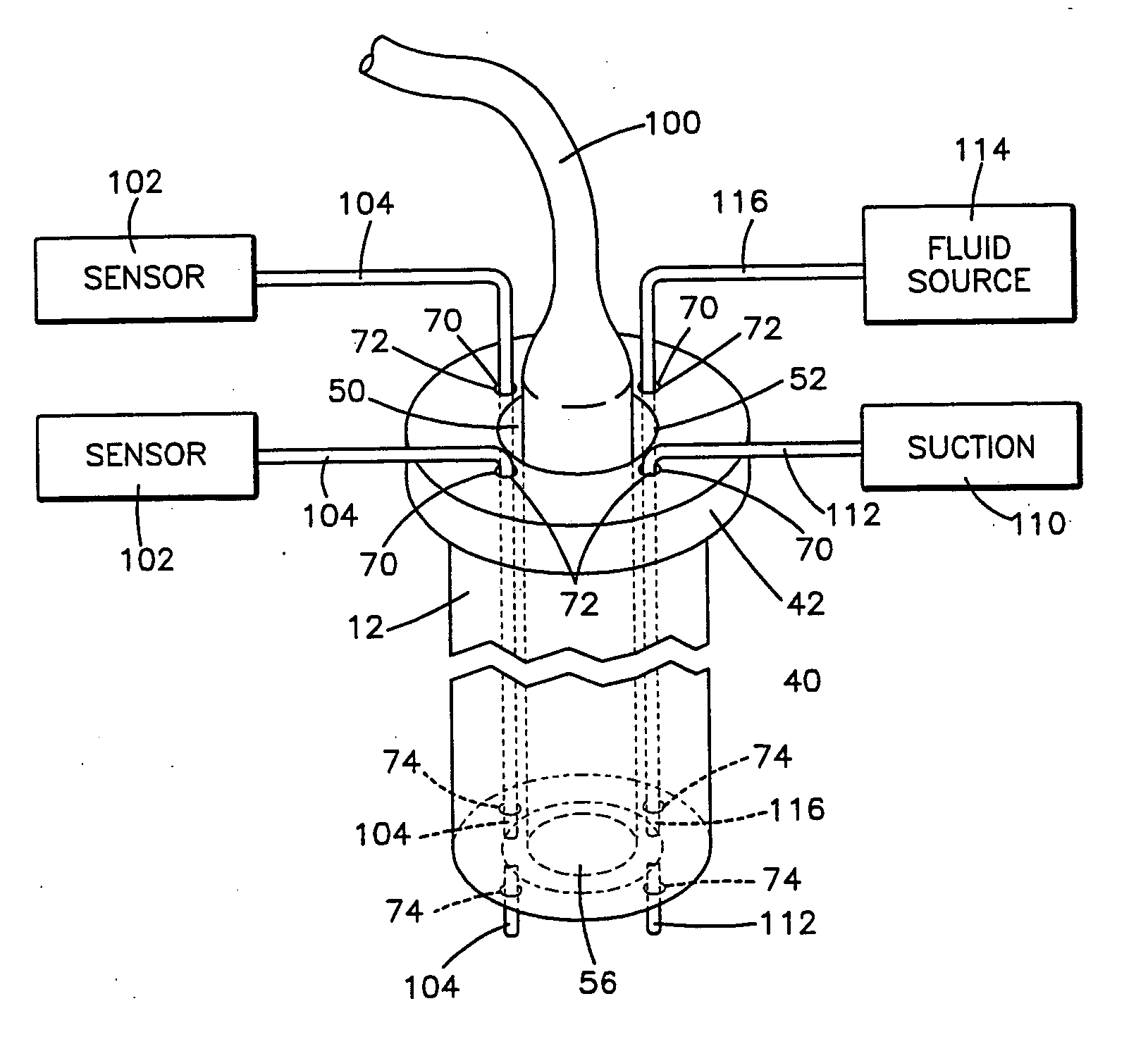 Apparatus for facilitating delivery of at least one device to a target site in a body