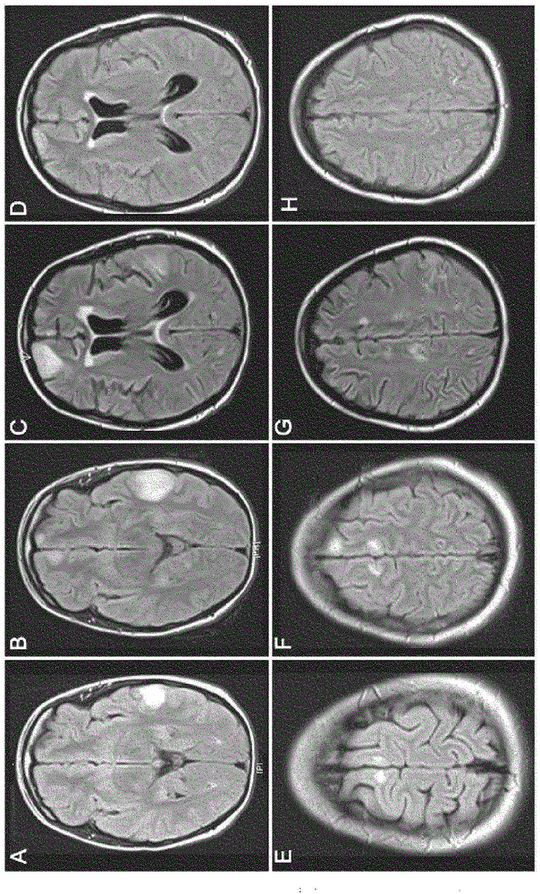 Diagnostic method for detecting a GABA(A) related autoimmune disease and related subject-matter