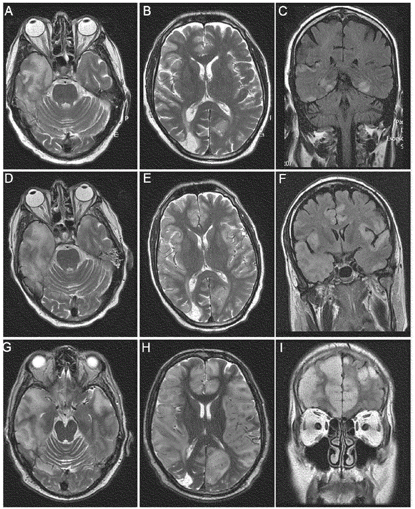 Diagnostic method for detecting a GABA(A) related autoimmune disease and related subject-matter