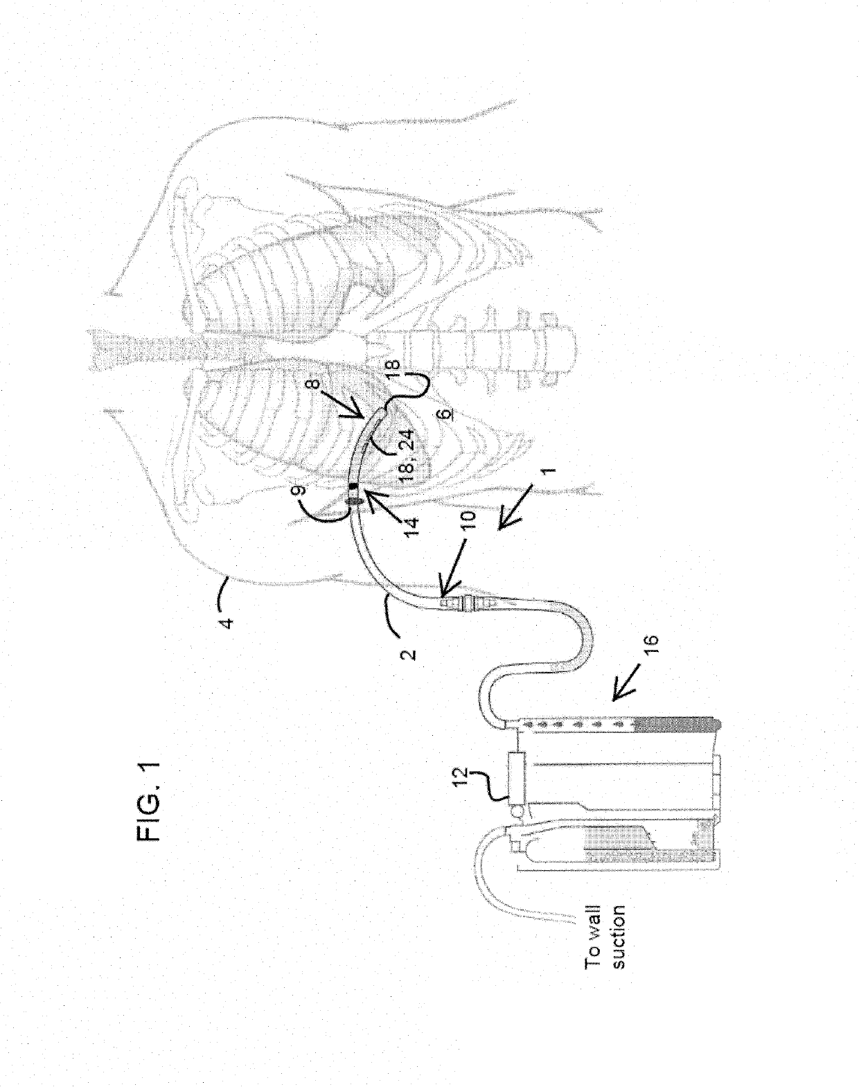 Thoracic catheter device