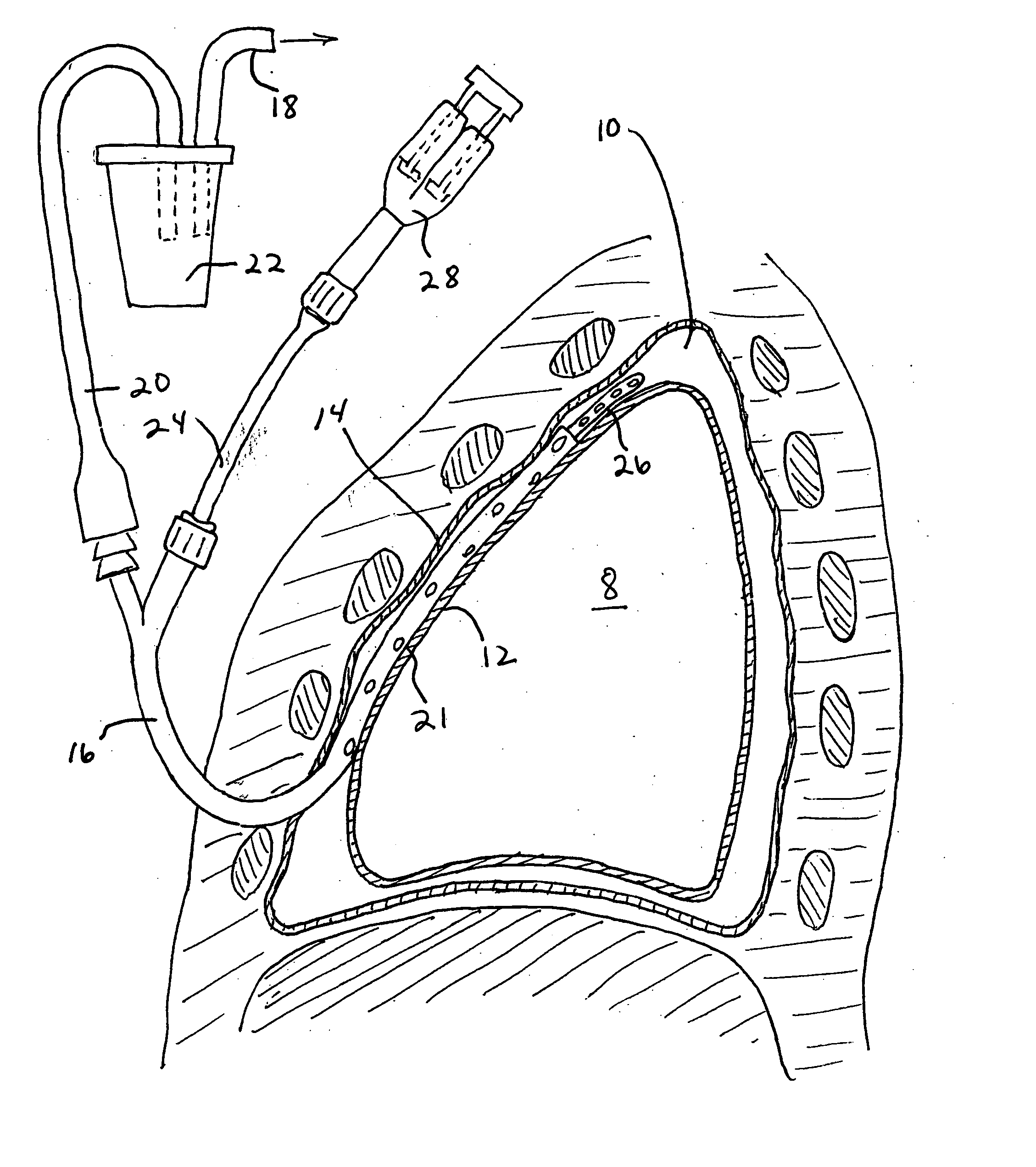 Pleural effusion treatment device, method and material