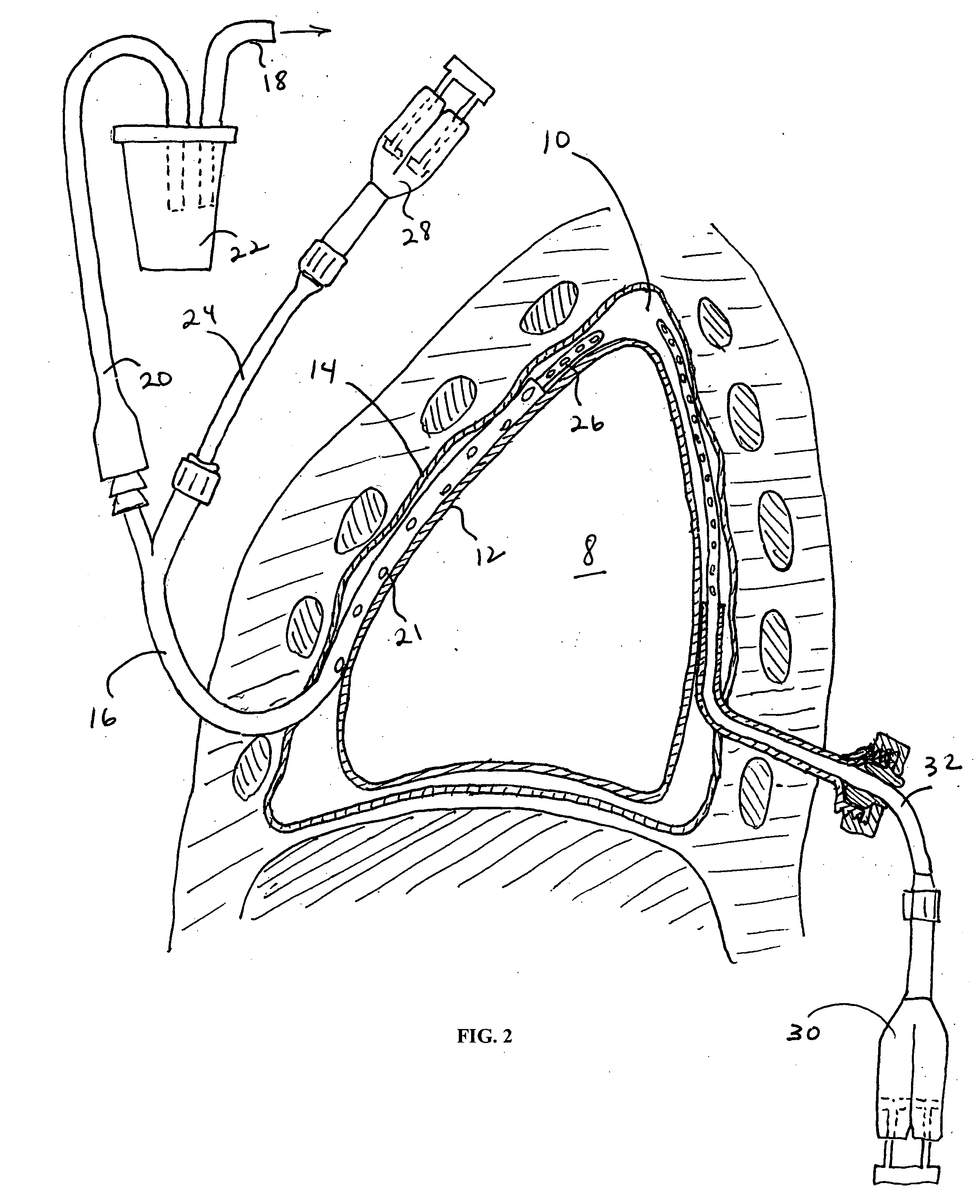 Pleural effusion treatment device, method and material