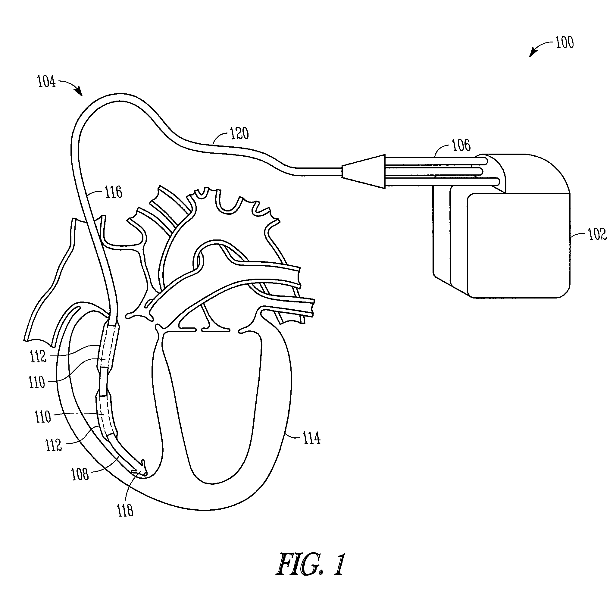 Lead assembly and related methods