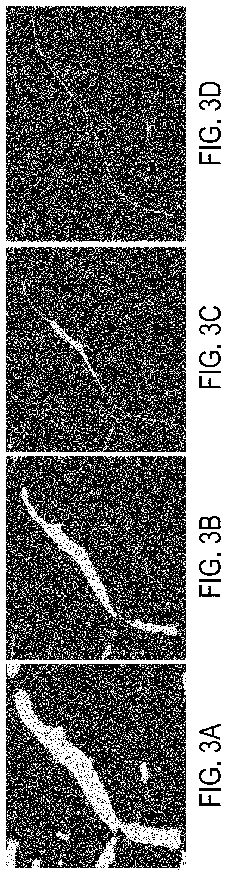 Methods for Extracting and Quantifying Diagnostic Biomarkers From Ultrasound Microvessel Images