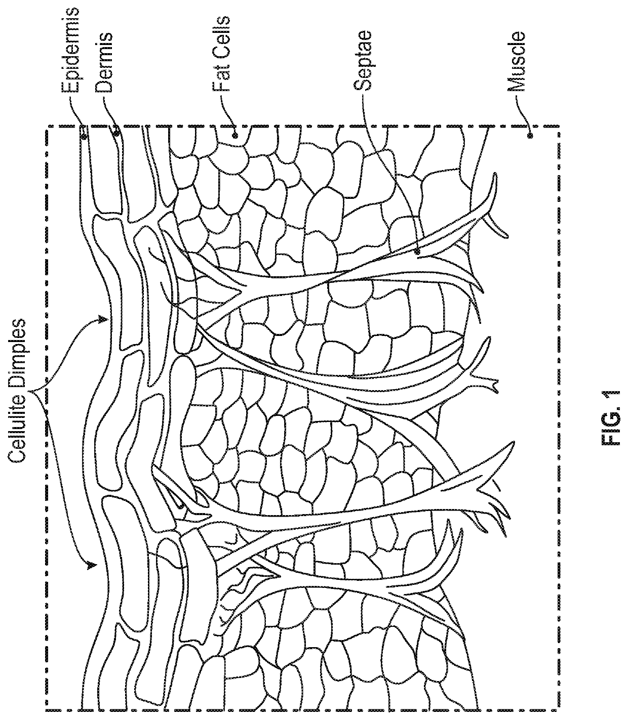 Devices and methods for reducing the appearance of cellulite