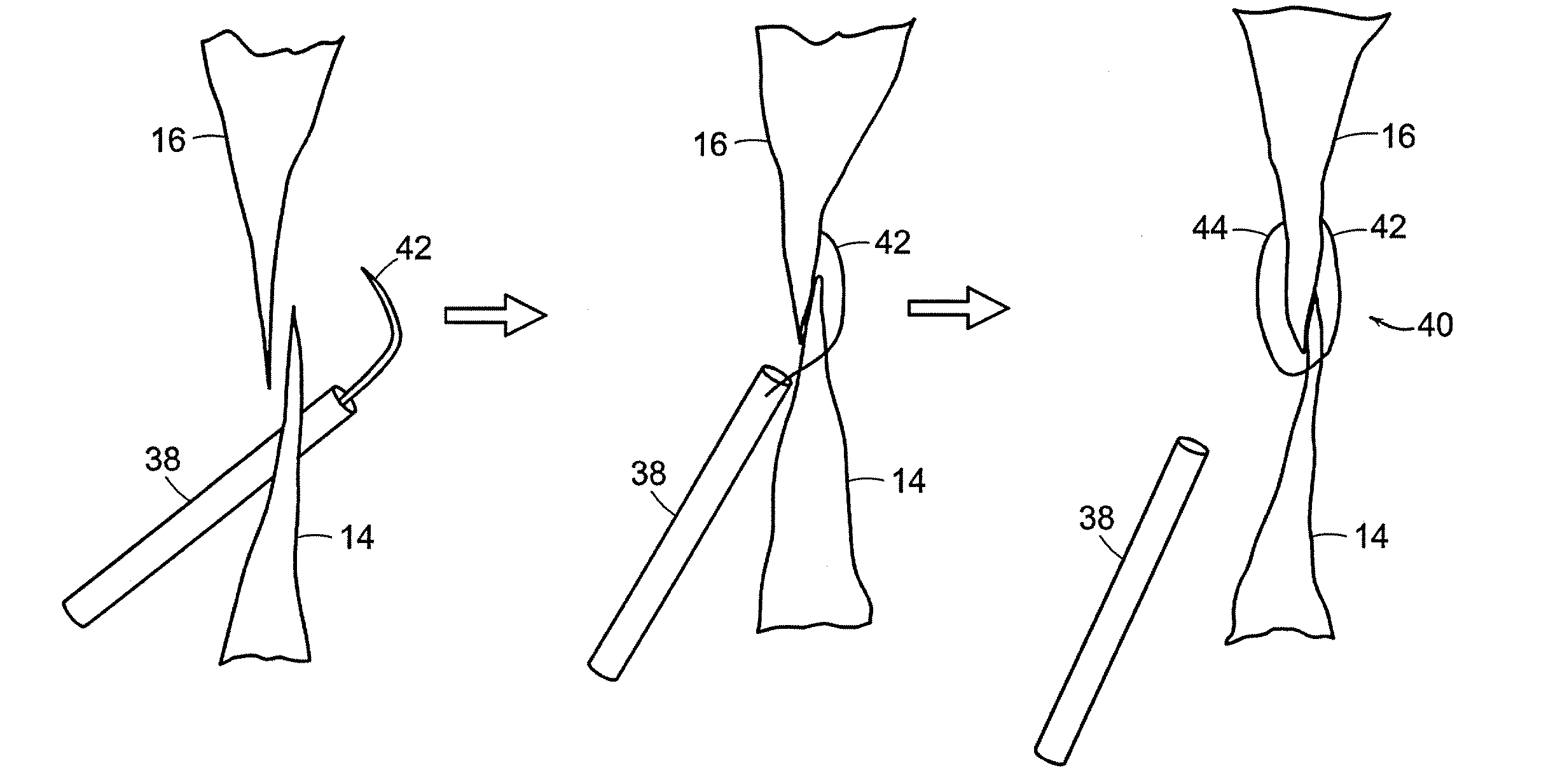 Patent foramen ovale (PFO) closure method and device