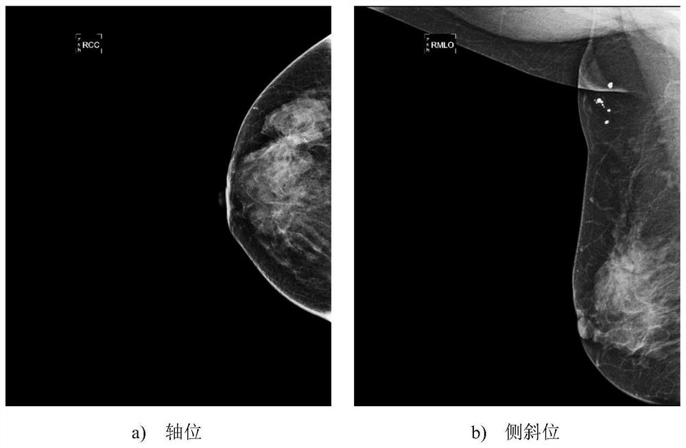 Histopathological grading method for breast cancer based on fusion of CNN and radiomics features