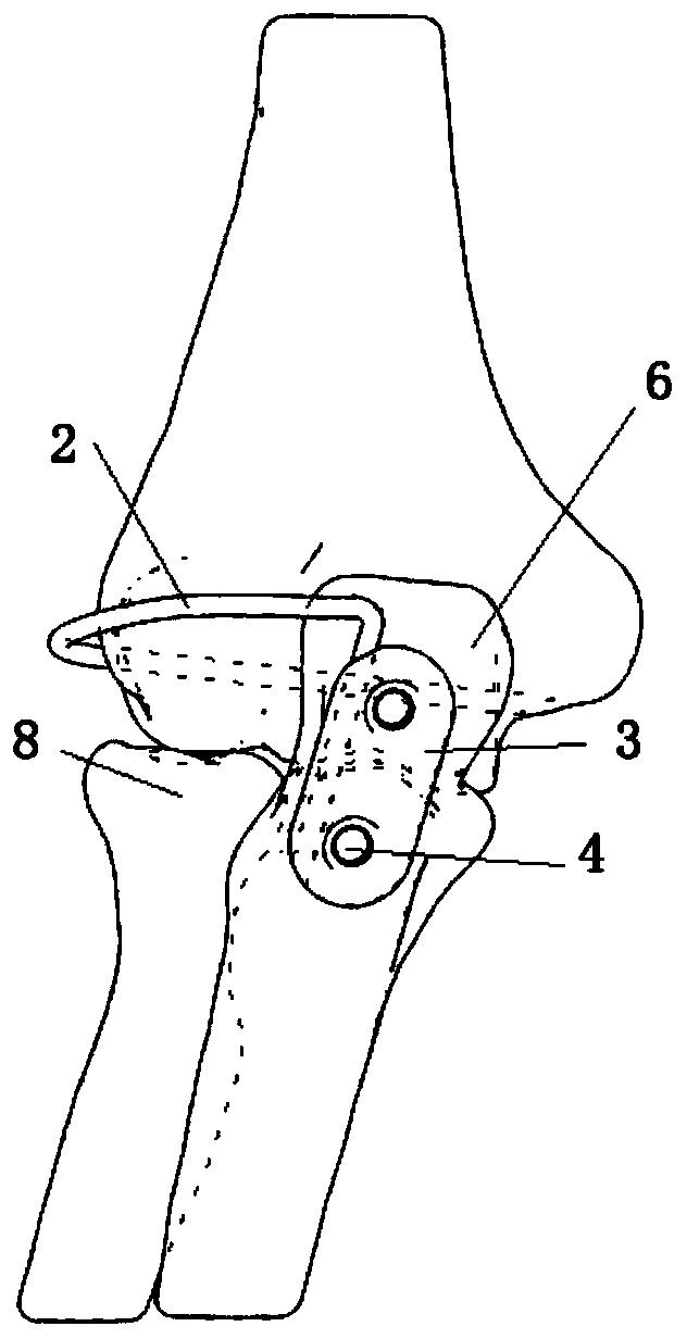 Internally implanted anatomical elbow joint stabilizer