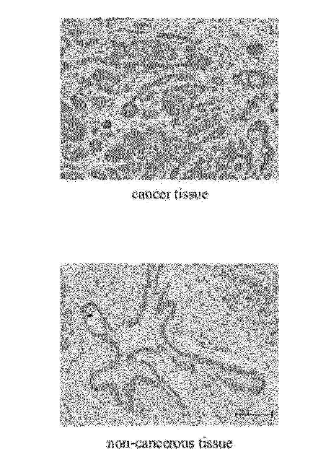 Serological marker for detecting pancreatic cancer and a method for using the serological marker