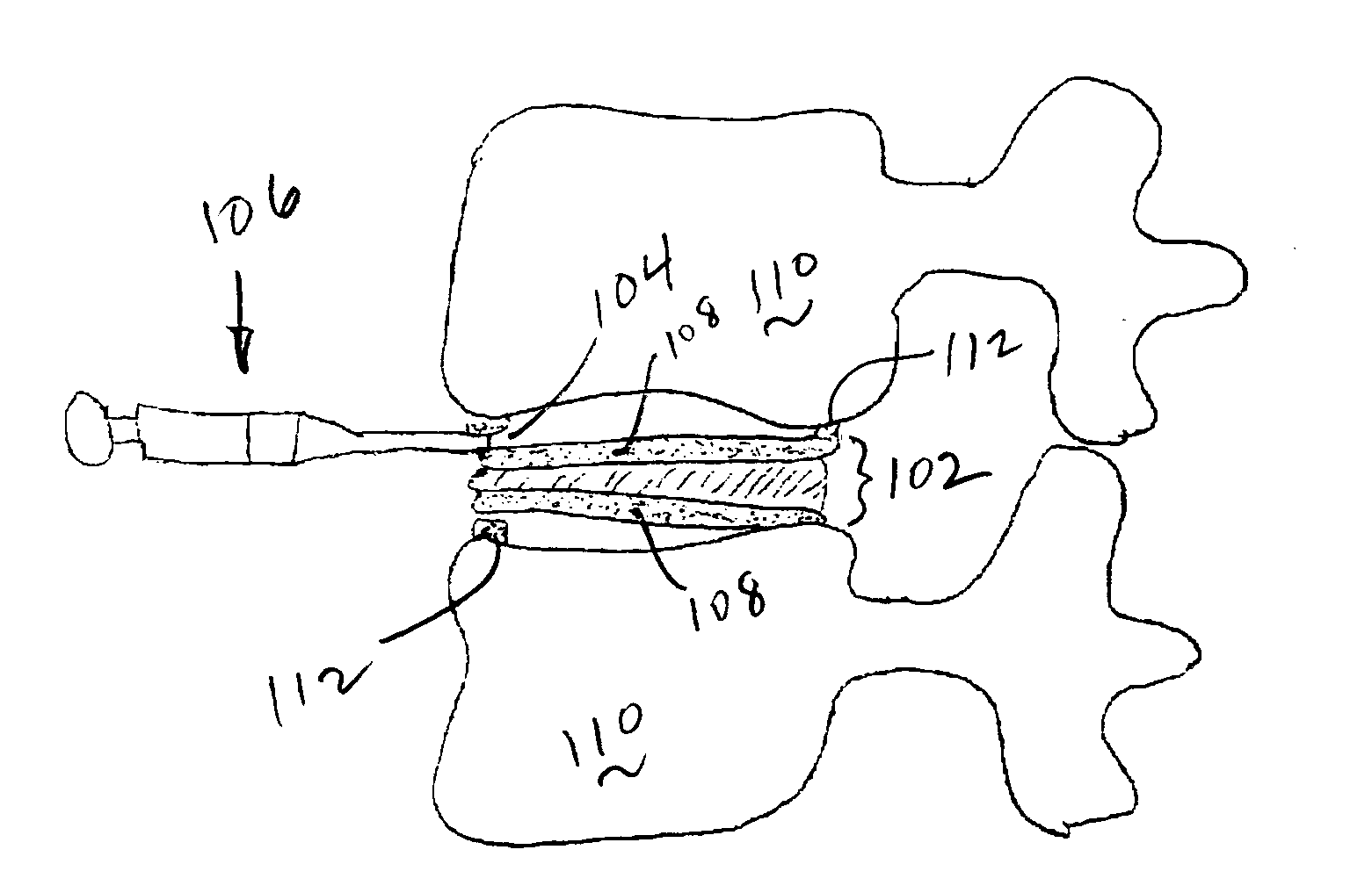 Cemented artificial disc replacements