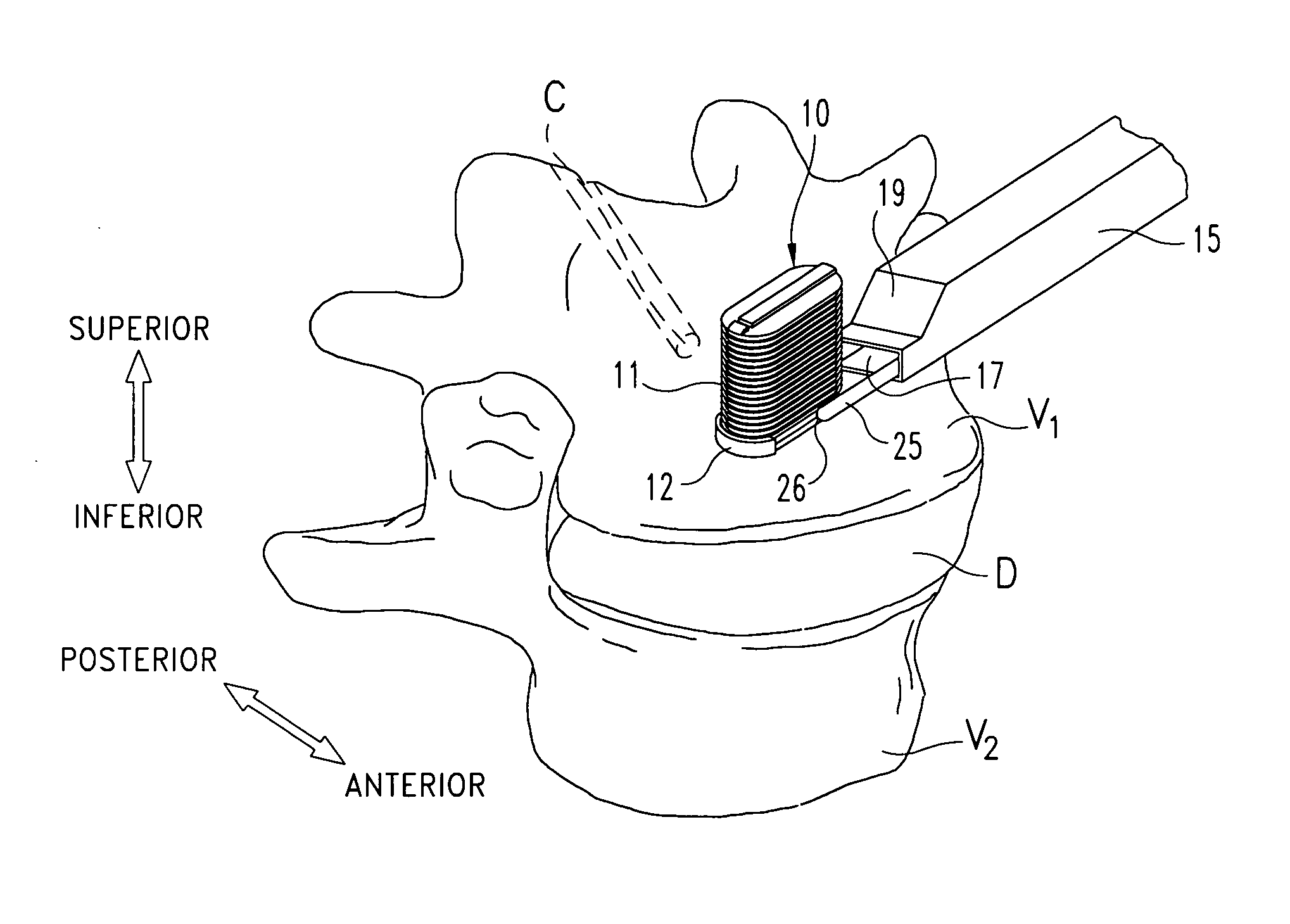 Apparatus and method for injecting fluent material at a distracted tissue site