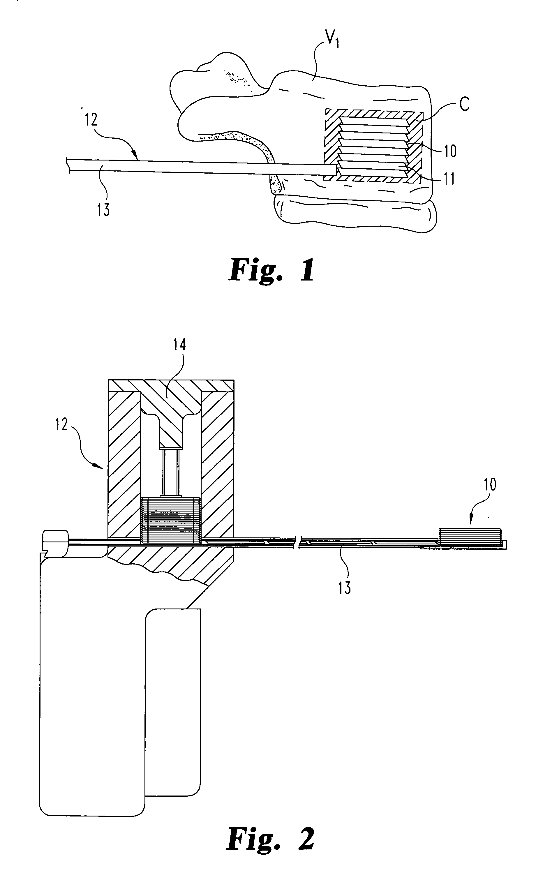 Apparatus and method for injecting fluent material at a distracted tissue site