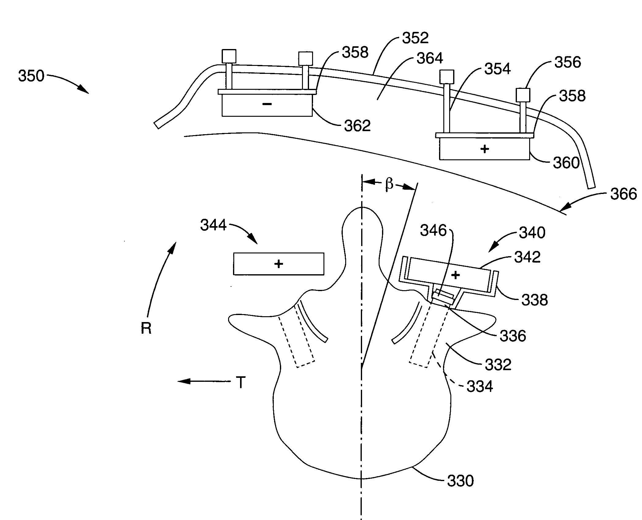 Apparatus and methods for magnetic alteration of anatomical features