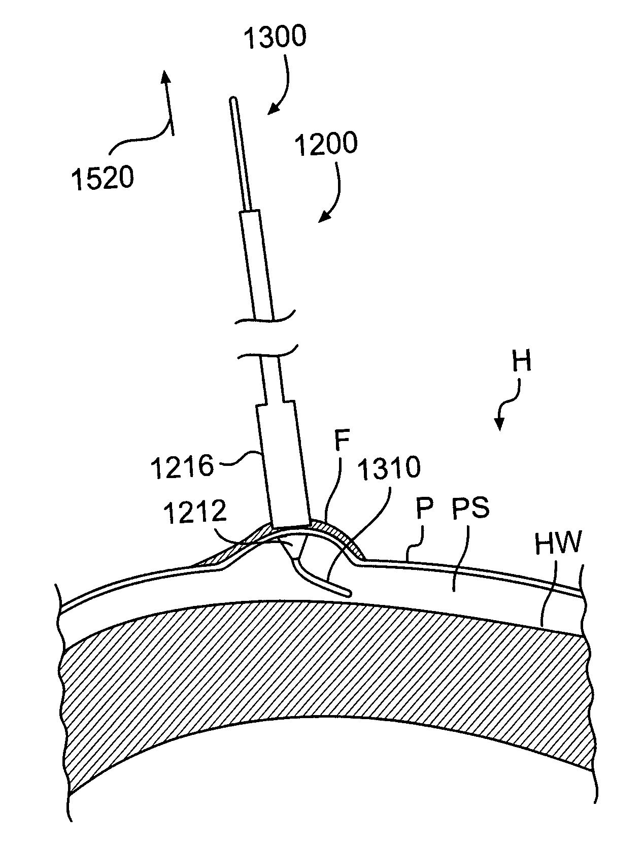 Devices and methods for pericardial access