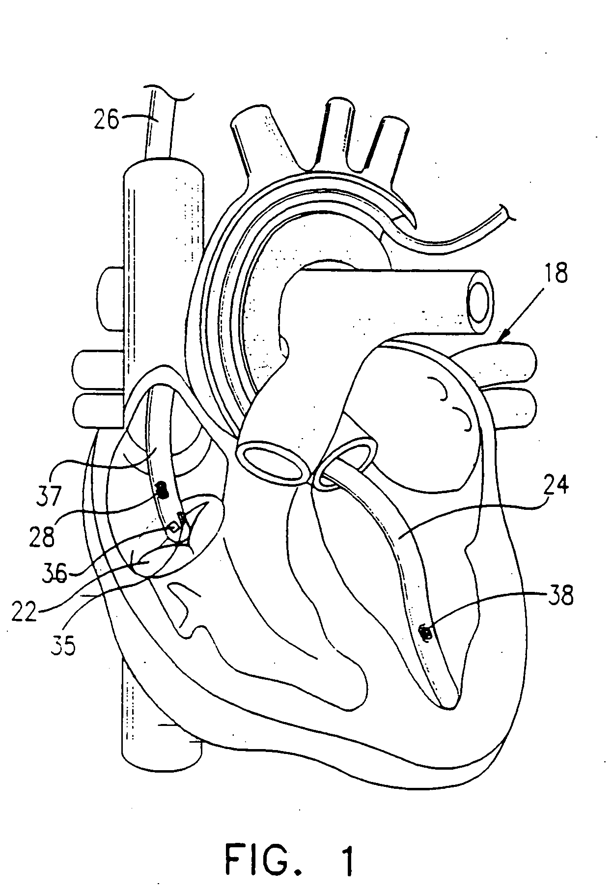 Method using implantable wireless transponder using position coordinates for assessing functionality of a heart valve