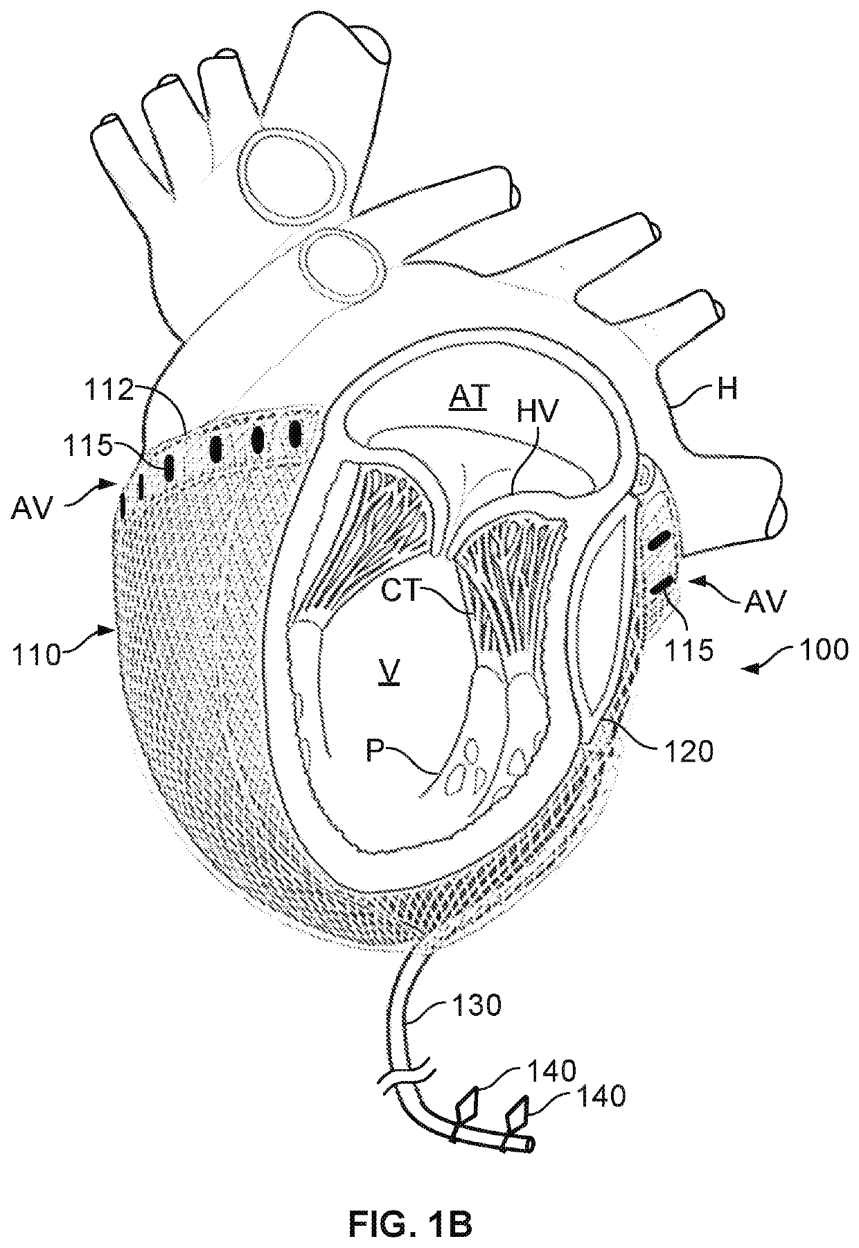 Cardiac treatment system and method