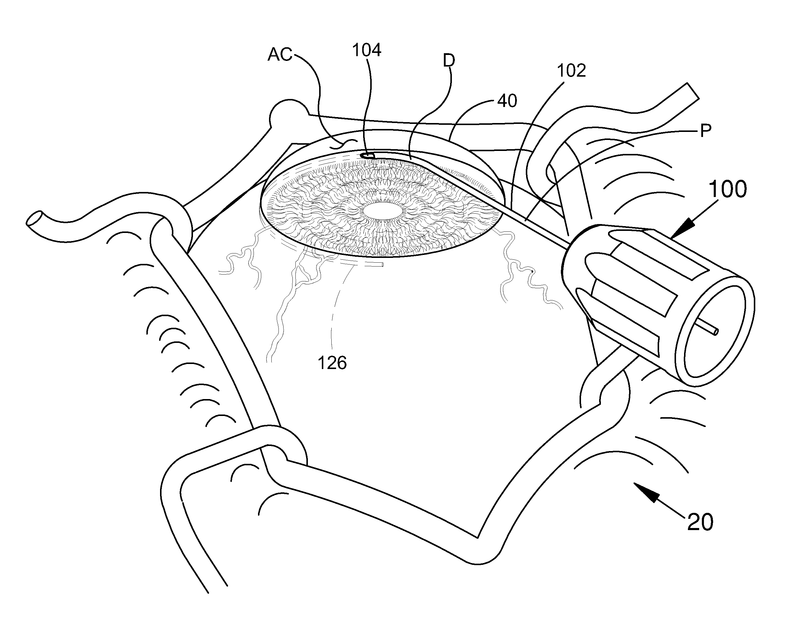 Ocular Implant System and Method