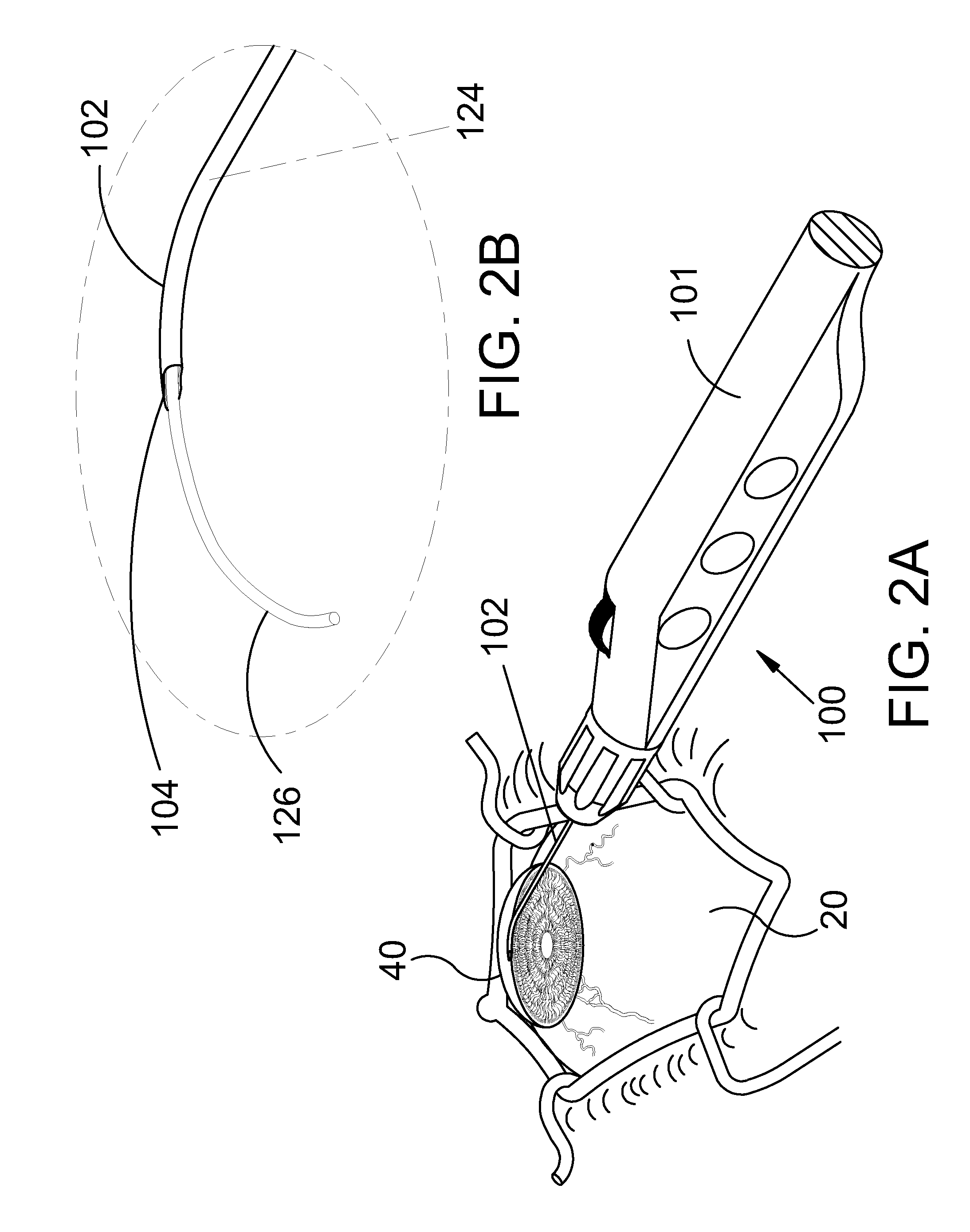 Ocular Implant System and Method