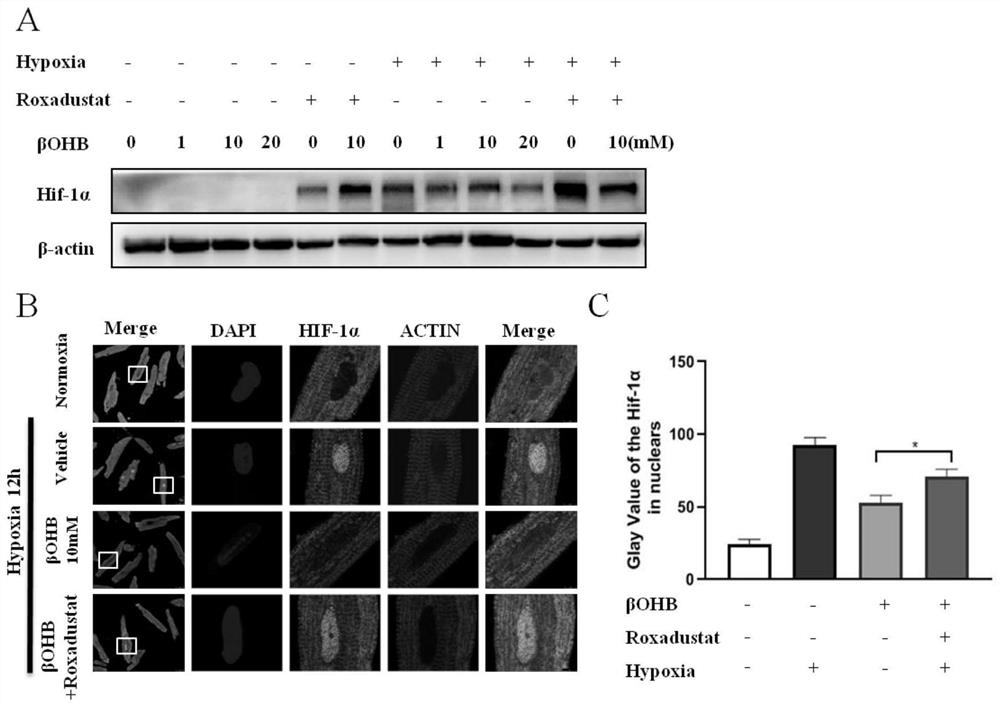 Application of HIF-1 alpha degradation inhibitor in preparation of drug for coronary heart disease with increased ketone body level