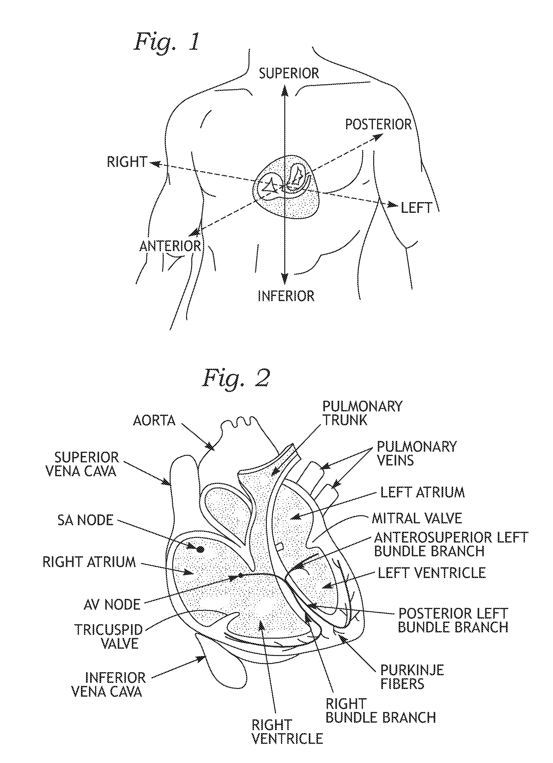 Physiologic tricuspid annuloplasty ring