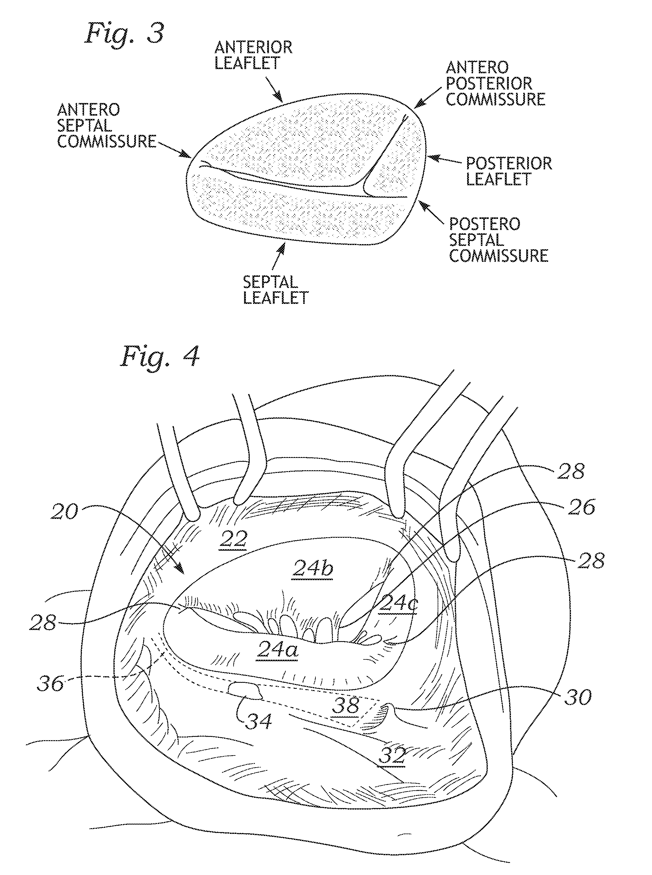 Physiologic tricuspid annuloplasty ring