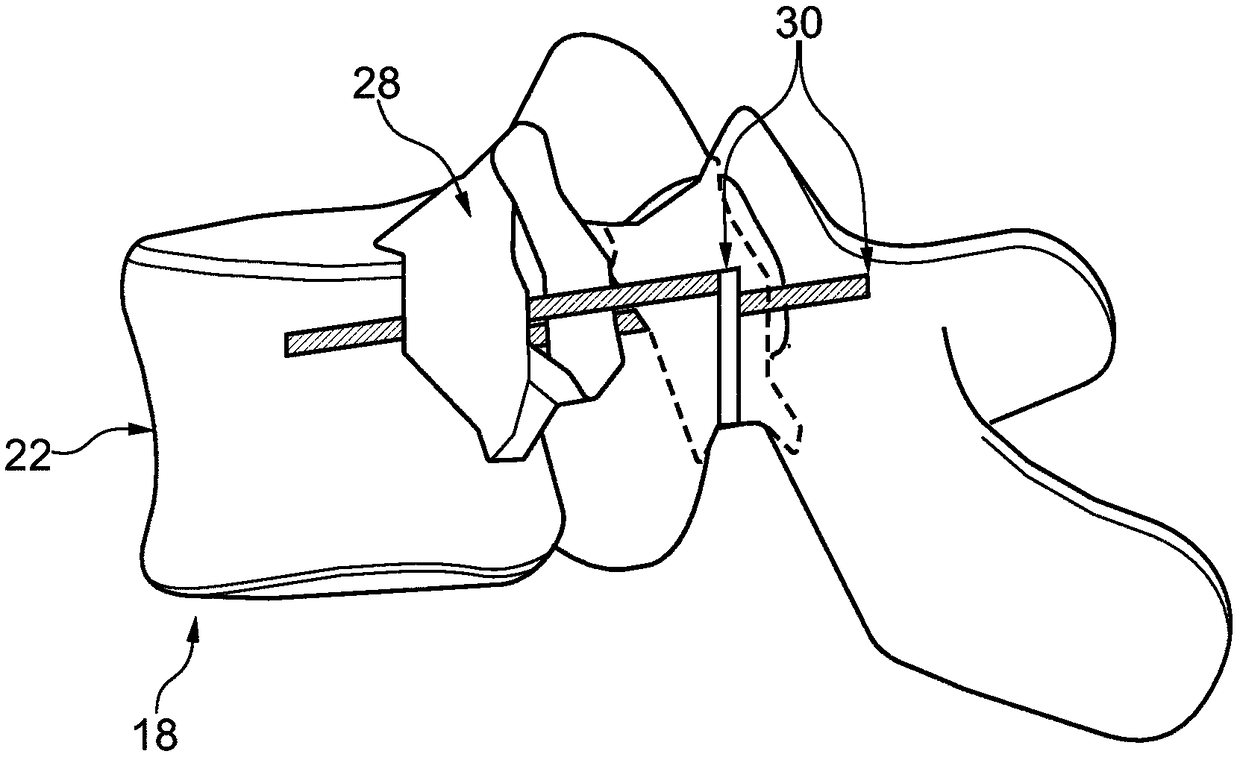 Determining an optimal placement of a pedicle screw