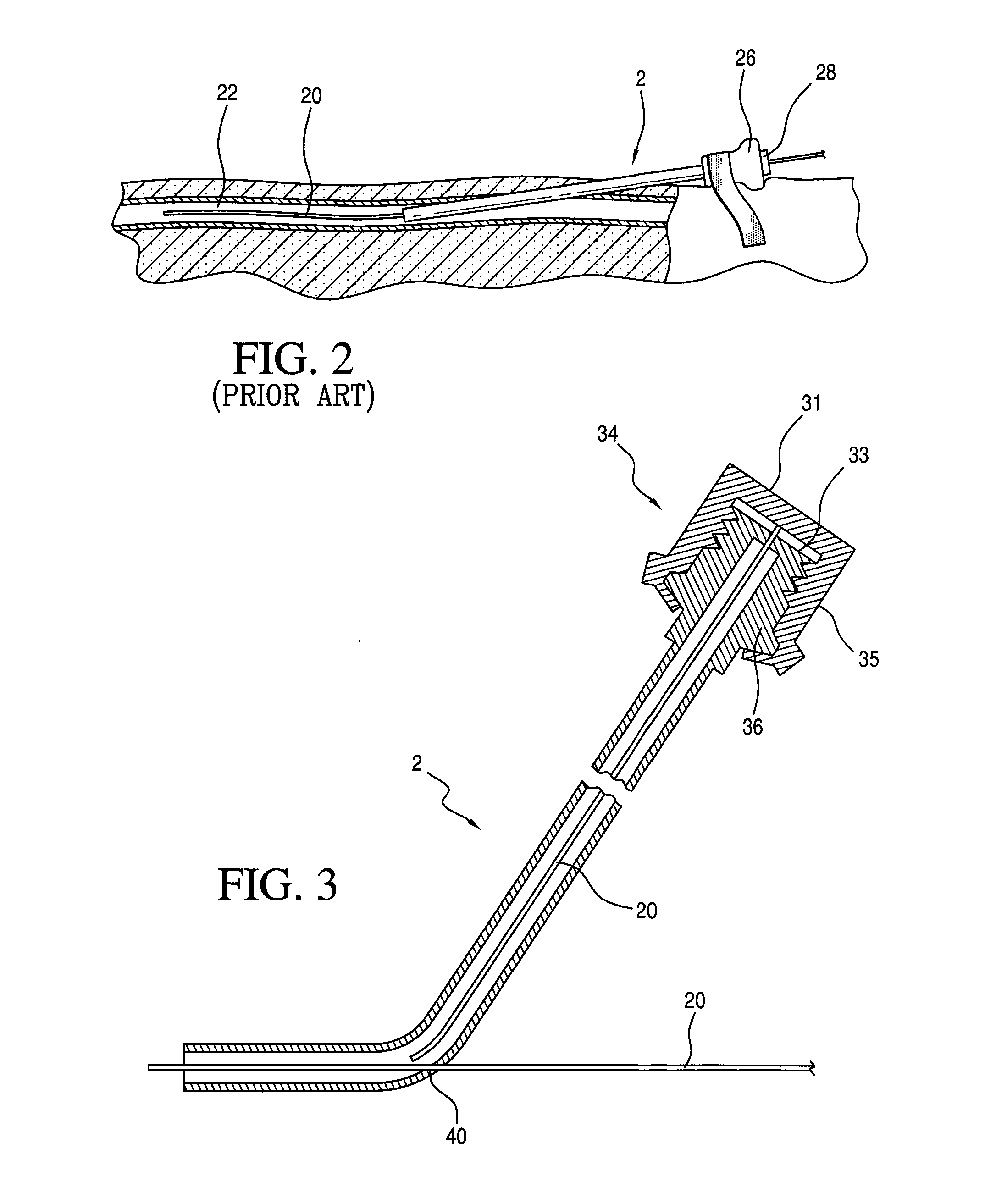 Medical Device for Anchoring a Guidewire During a Percutaneous Coronary Intervention