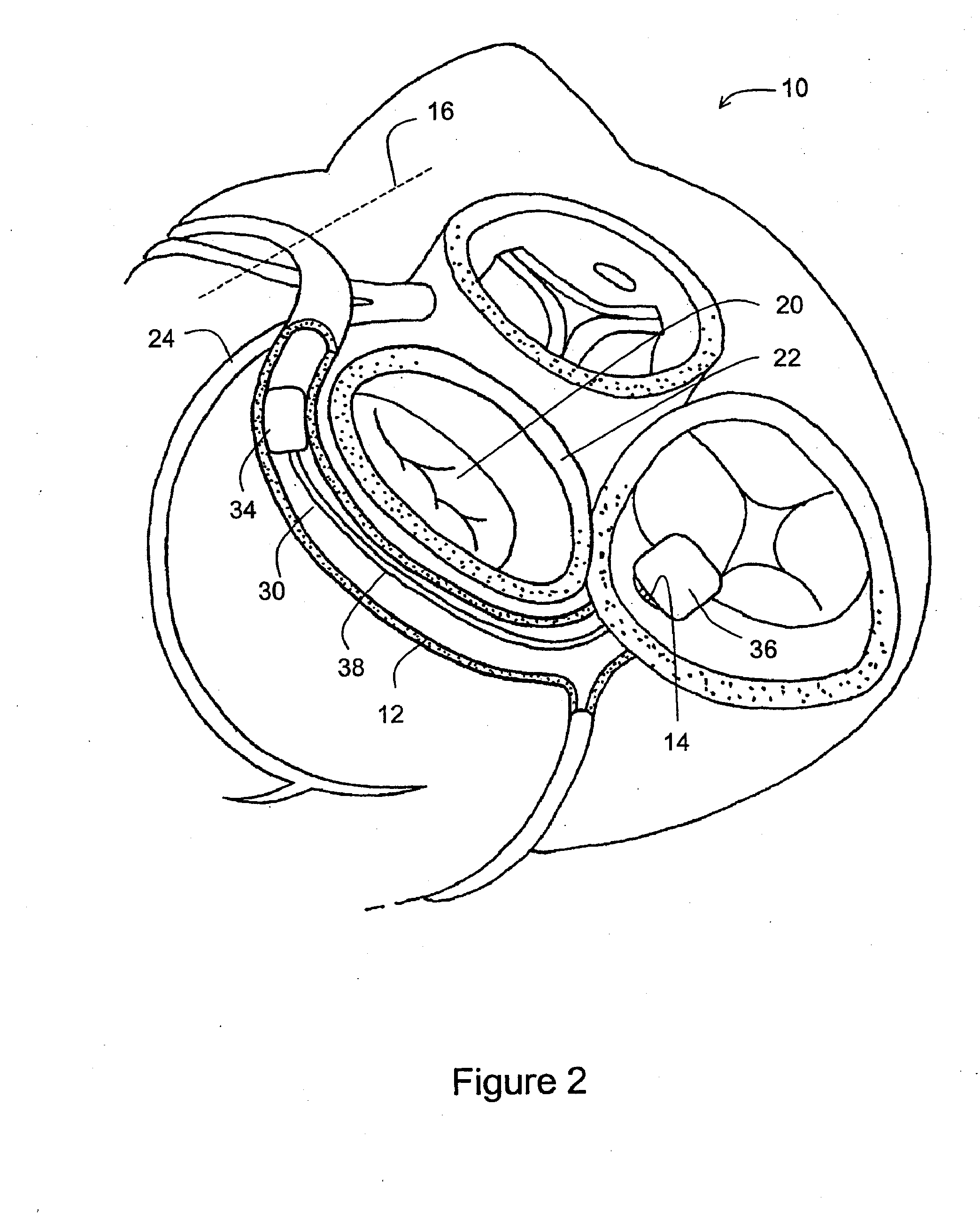 Tissue Shaping Device with Integral Connector and Crimp