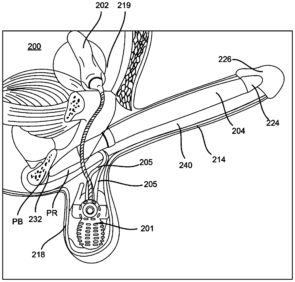 Inflatable penile prosthesis with reinforced cylinder