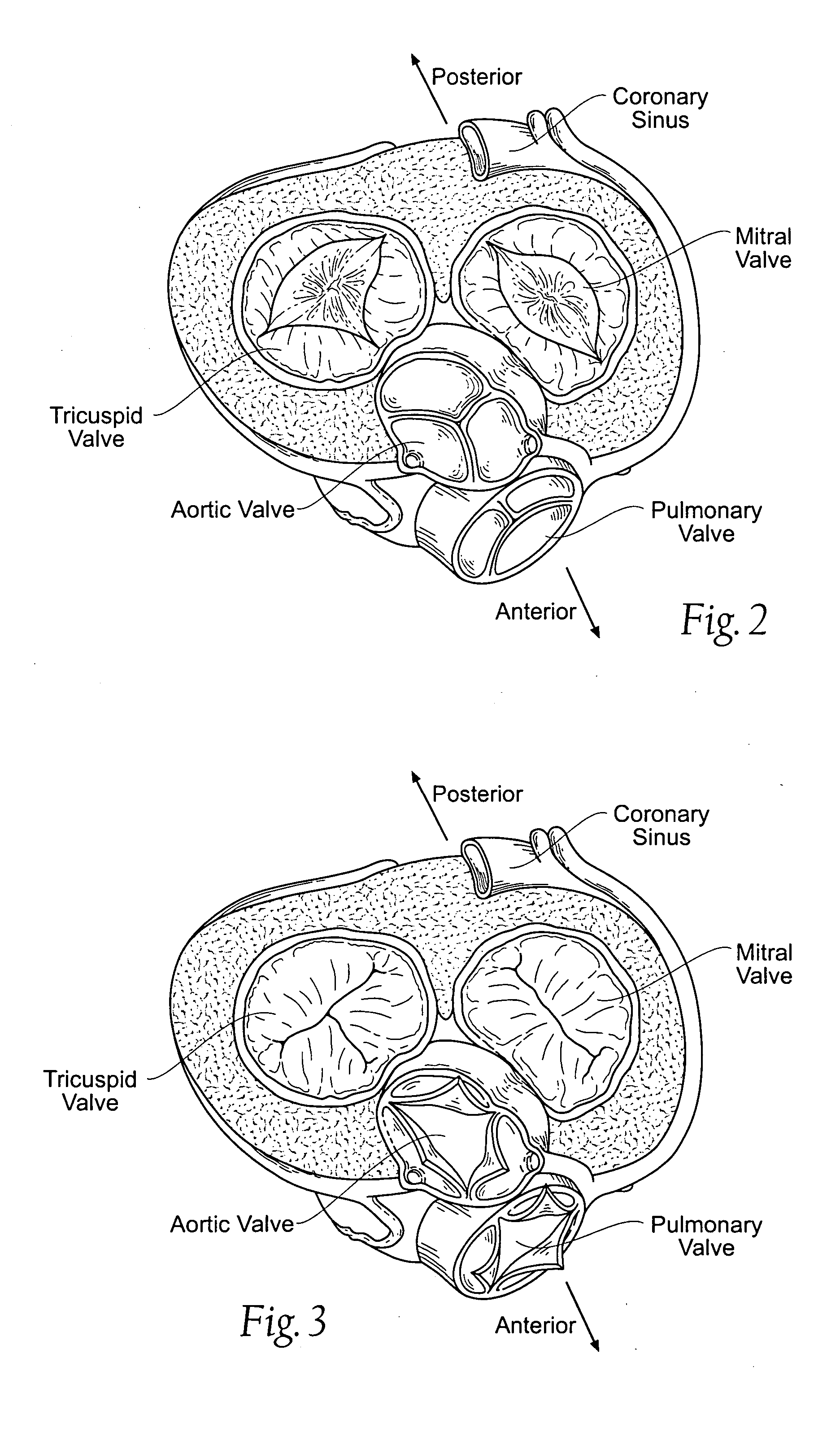 Devices, systems, and methods for supporting tissue and/or structures within a hollow body organ