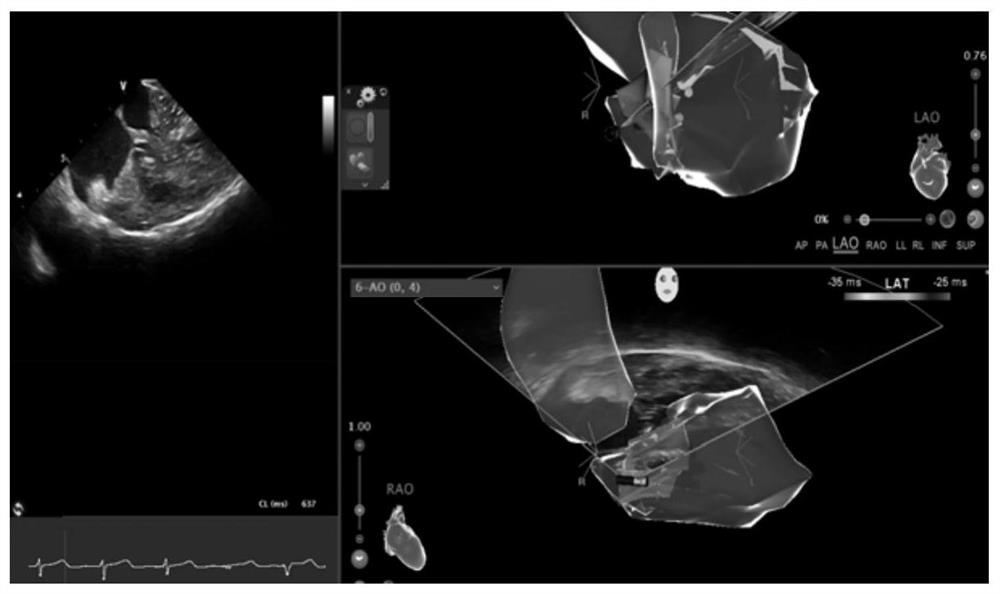 System for displaying trans-aortic valve pressure in real time in ventricular septum ablation