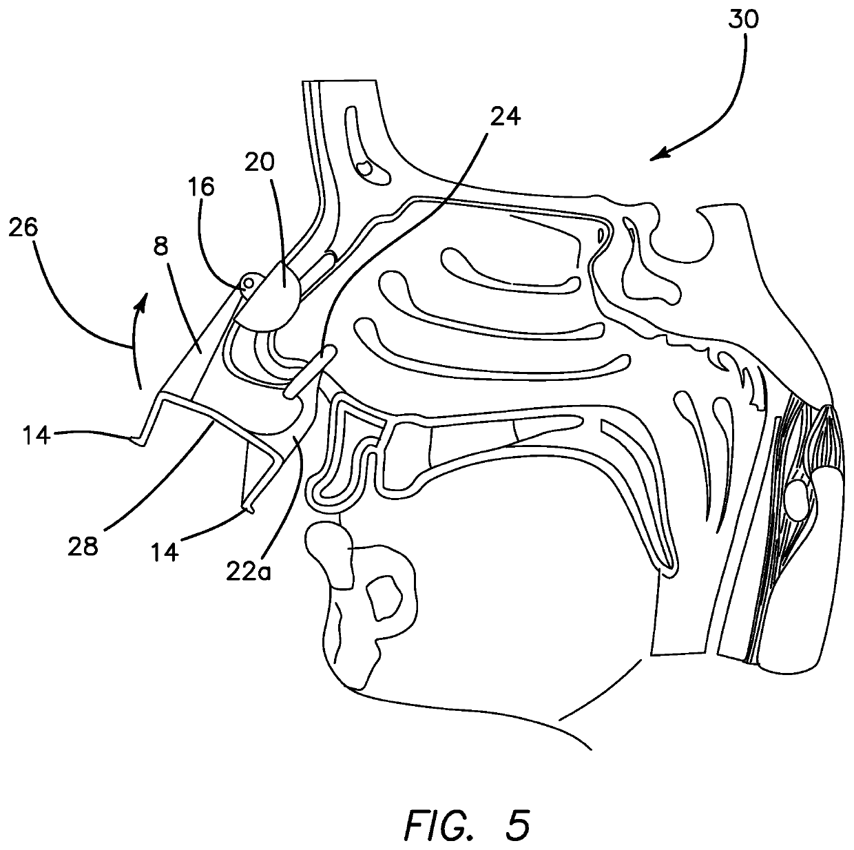 Compressive Nasal Device and Method for Using the Same