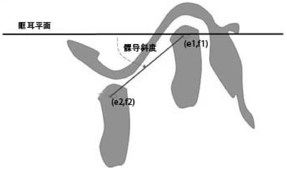 Method for positioning temporomandibular joints based on CBCT