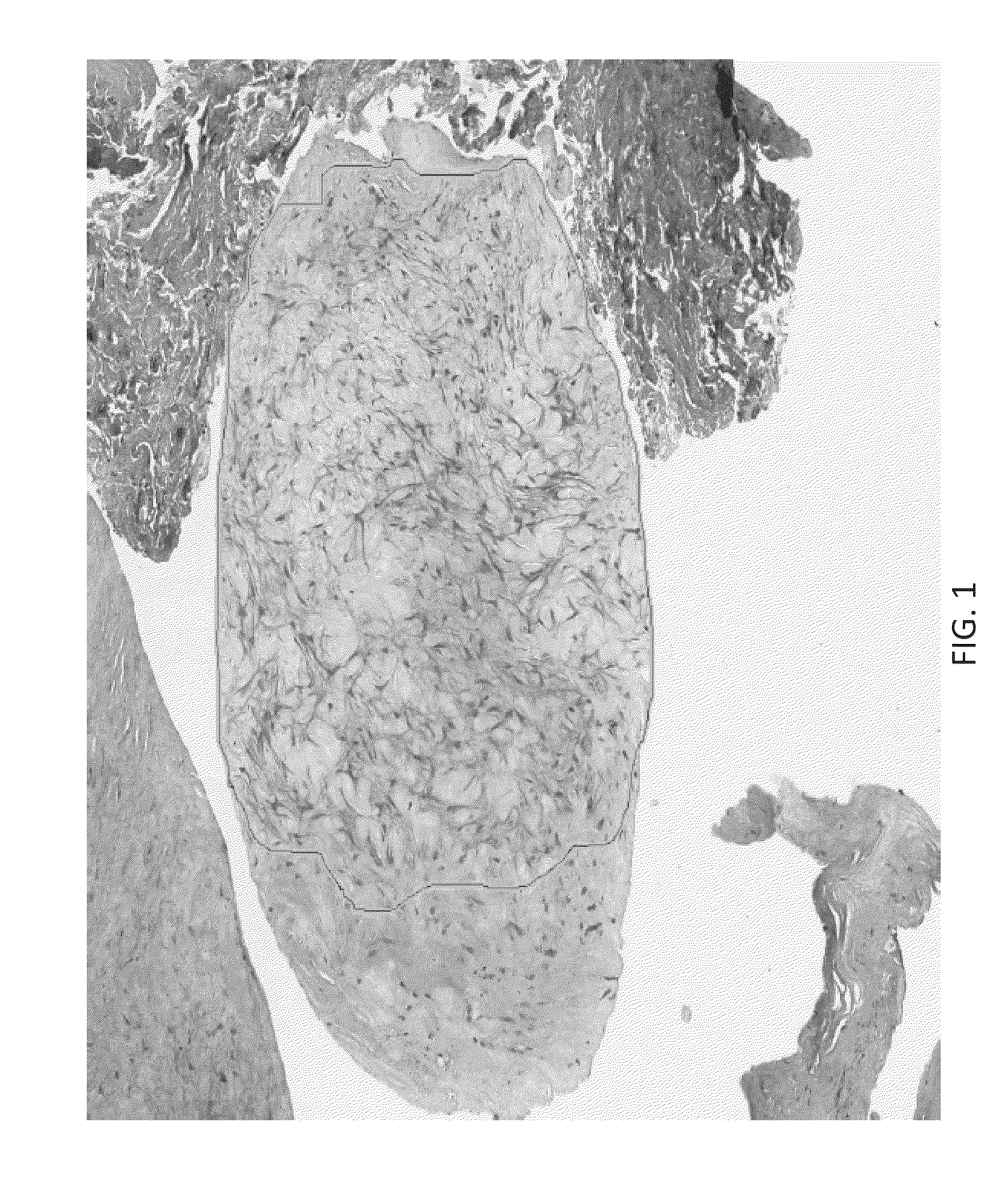 Devices and methods for predicting and preventing restenosis