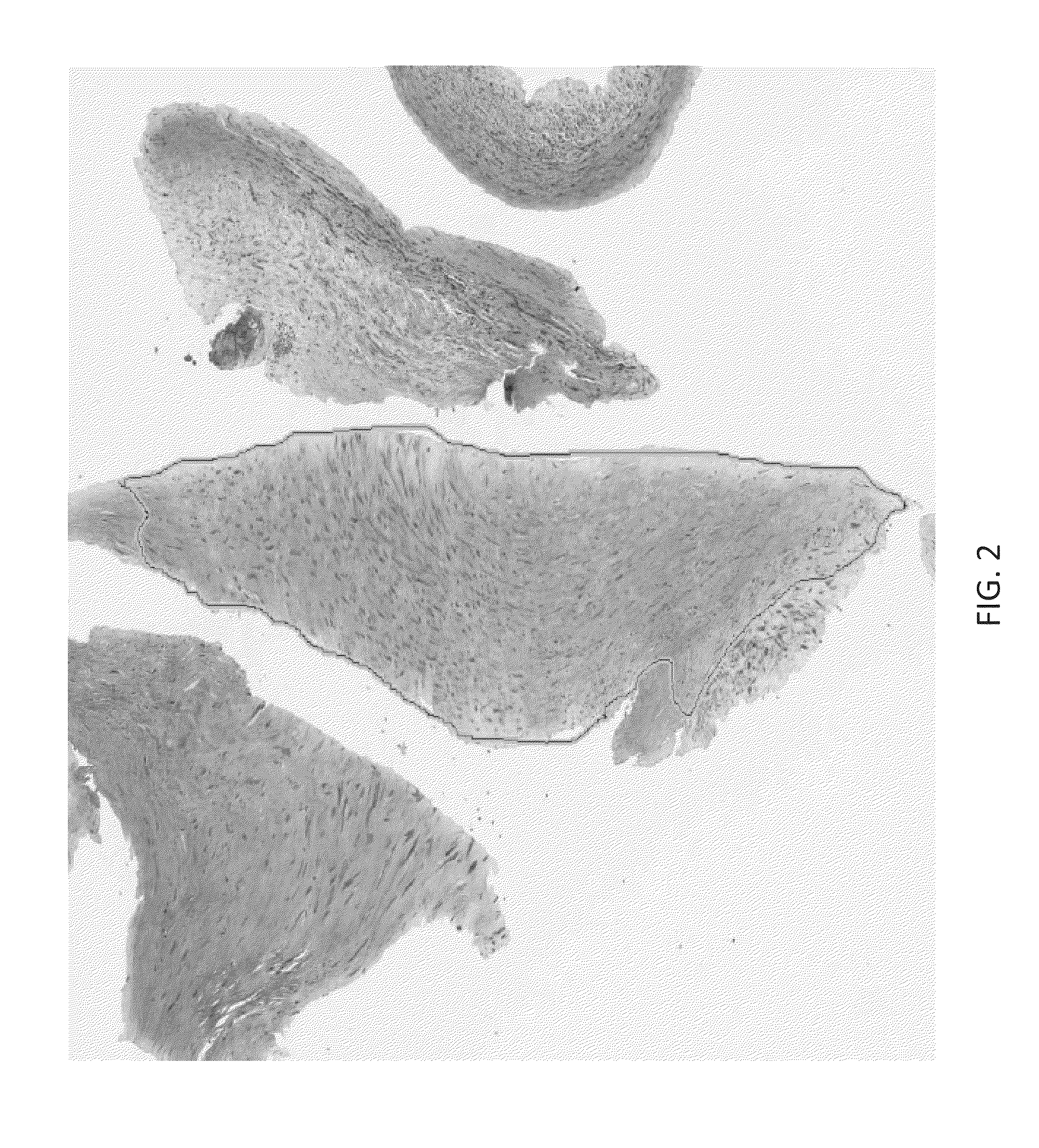 Devices and methods for predicting and preventing restenosis