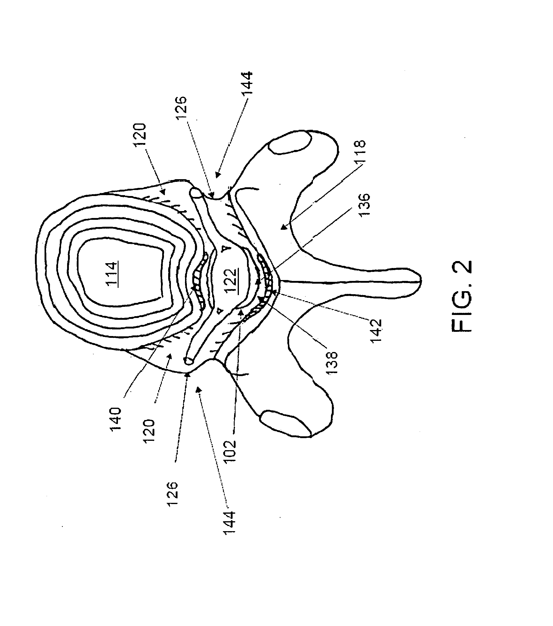 Discectomy devices and methods