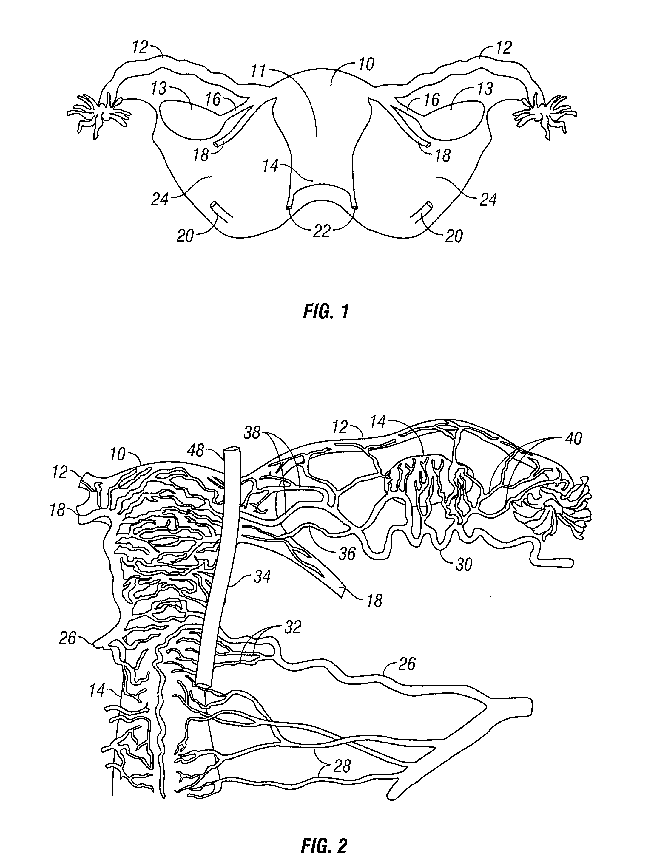 Method and apparatus for sealing tissue
