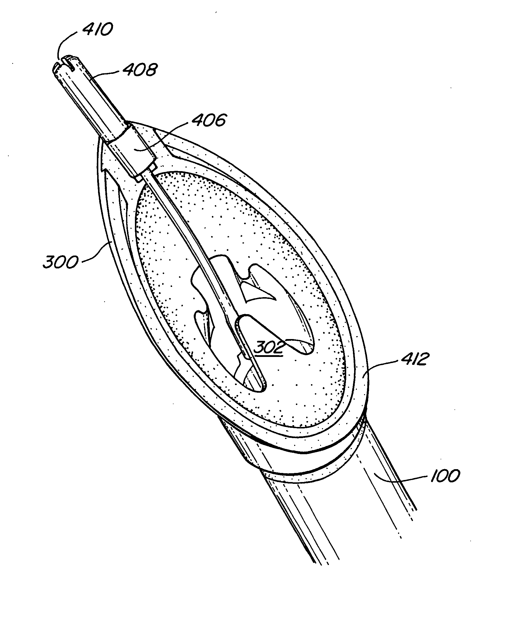 Laryngeal airway device