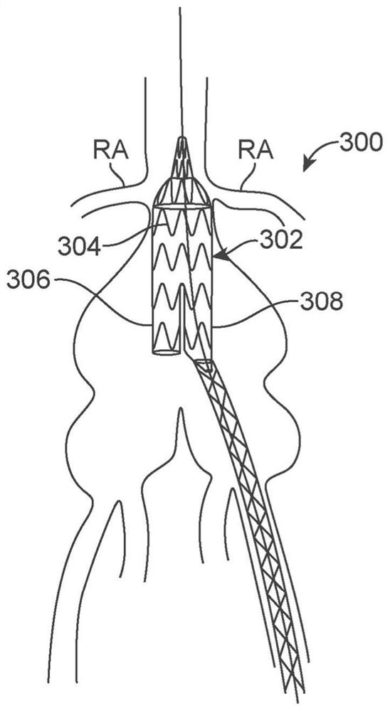 Bifurcating branch modular iliac branch device