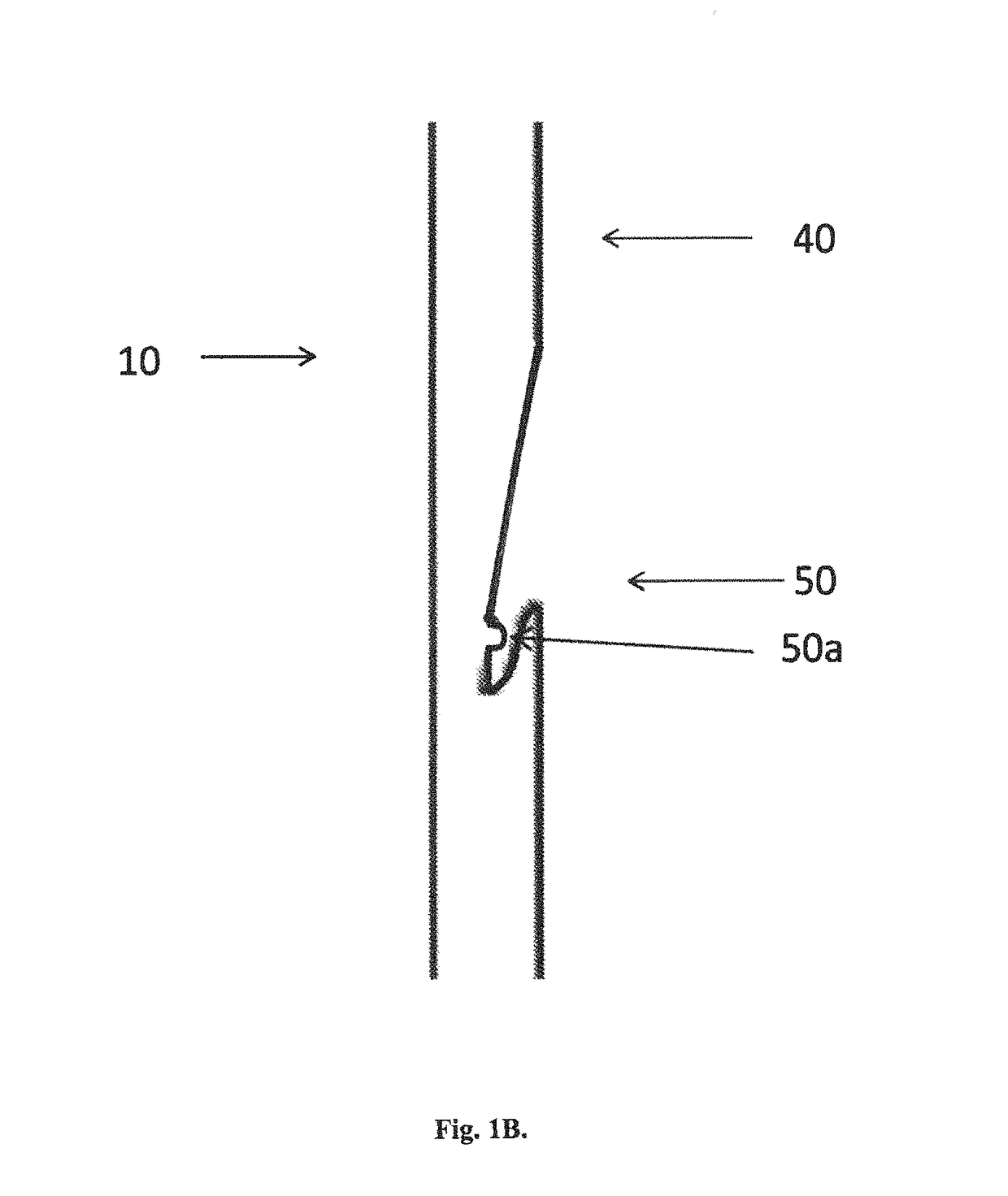 Locking needle for inflatable penile prosthesis