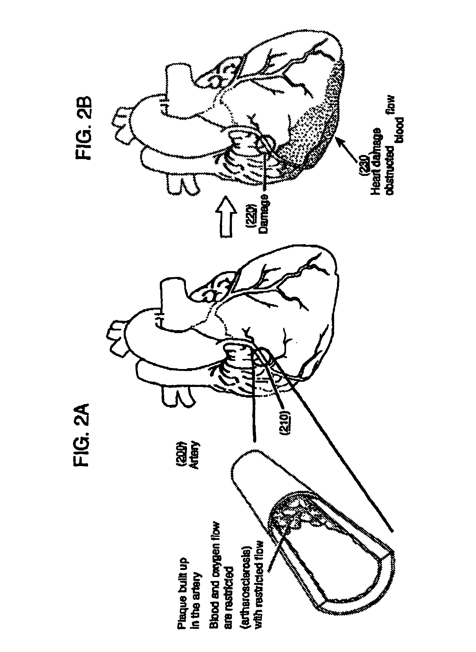 High-viscosity hyaluronic acid compositions to treat myocardial conditions