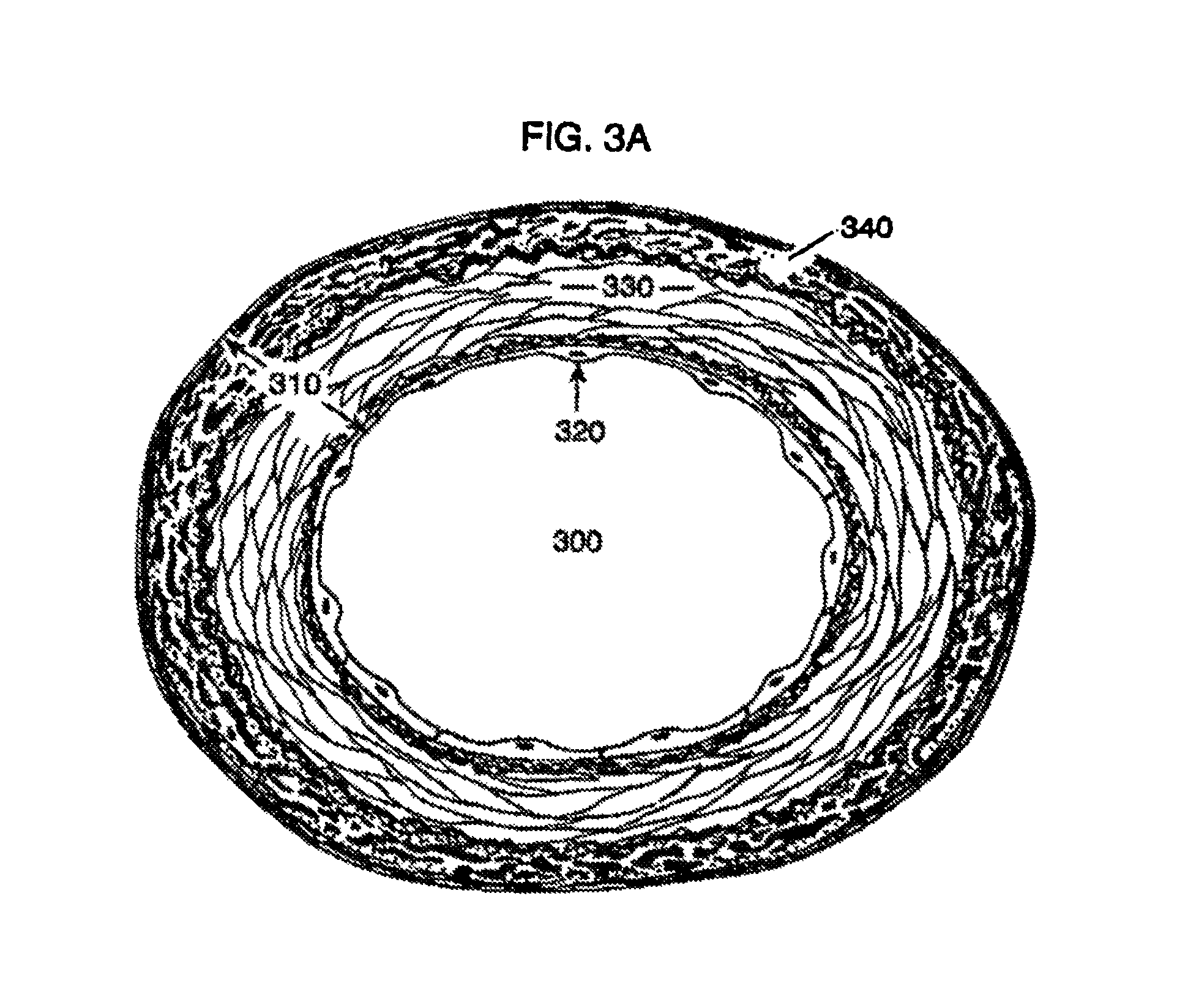 High-viscosity hyaluronic acid compositions to treat myocardial conditions