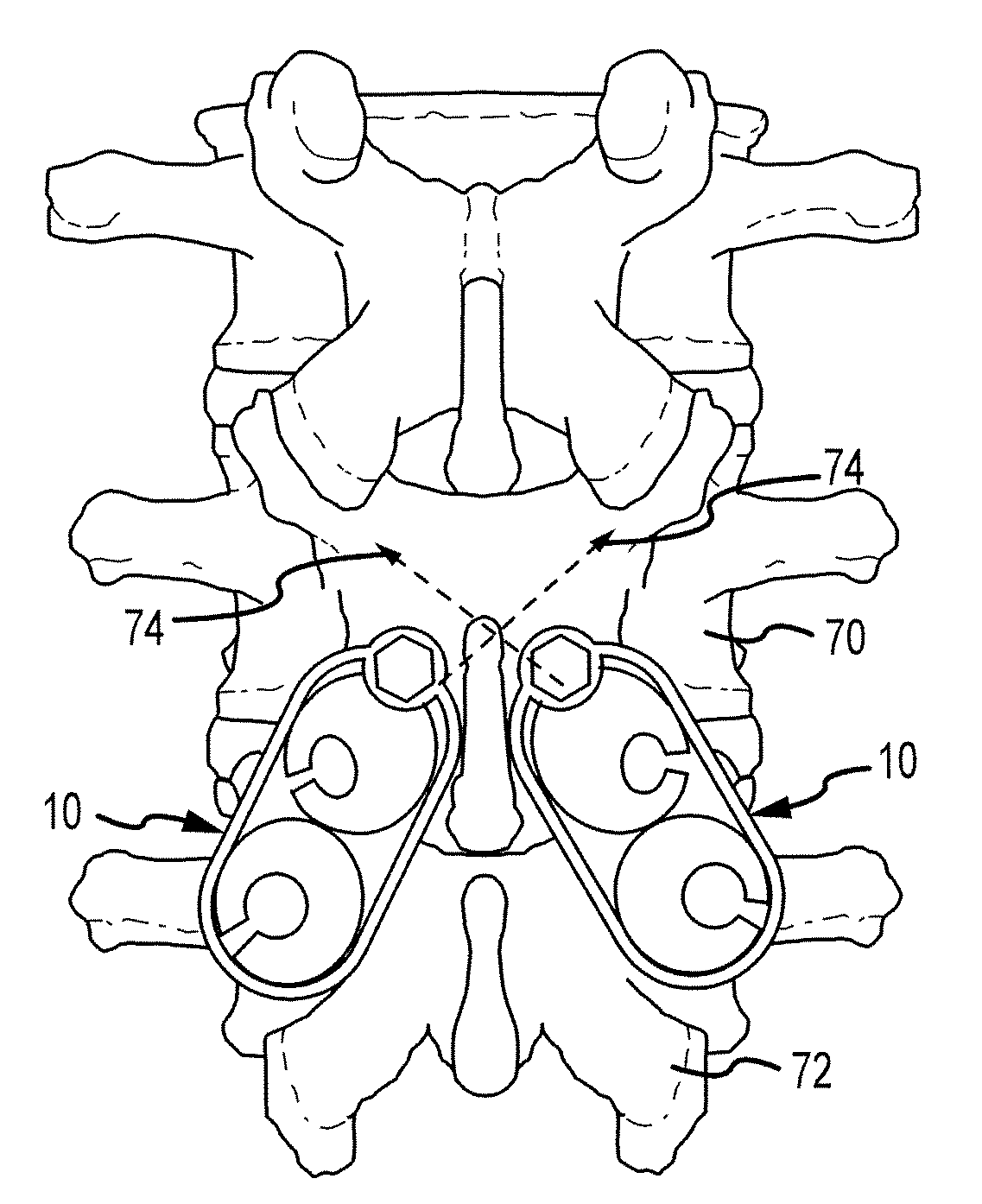 System and method for spinal instrumentation