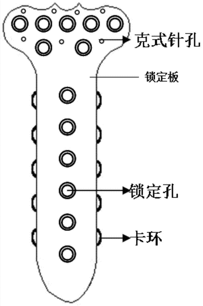 Anatomical locked hook plate with memory alloy