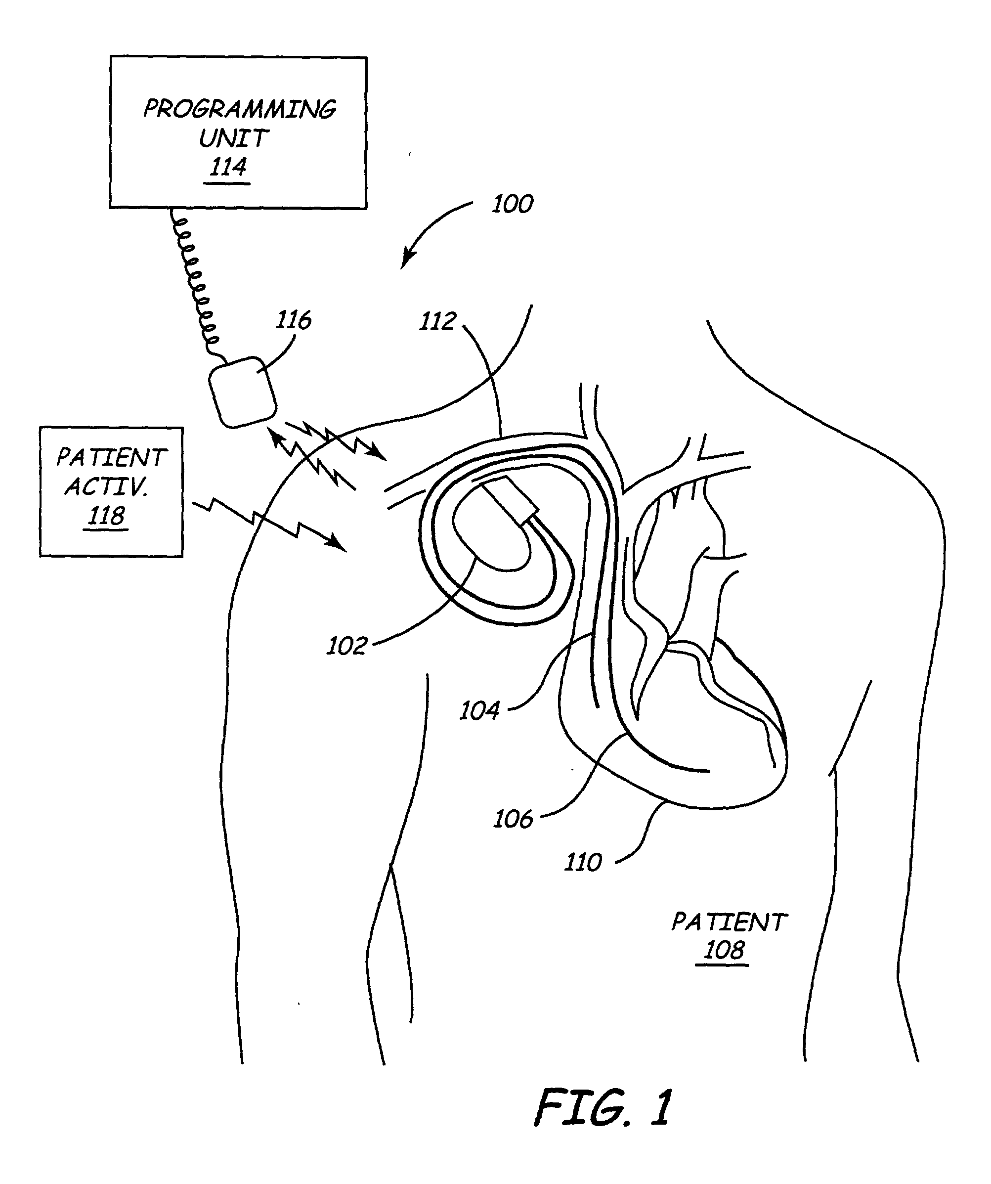 Implantable medical device (IMD) system configurable to subject a patient to a stress test and to detect myocardial ischemia within the patient
