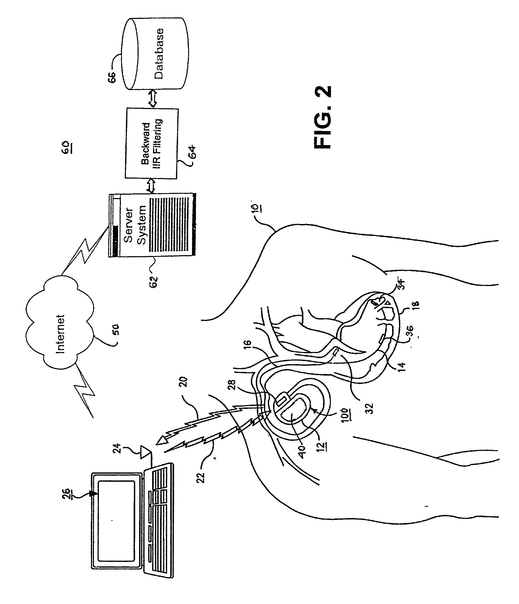 Methods and apparatus for filtering EGM signals detected by an implantable medical device