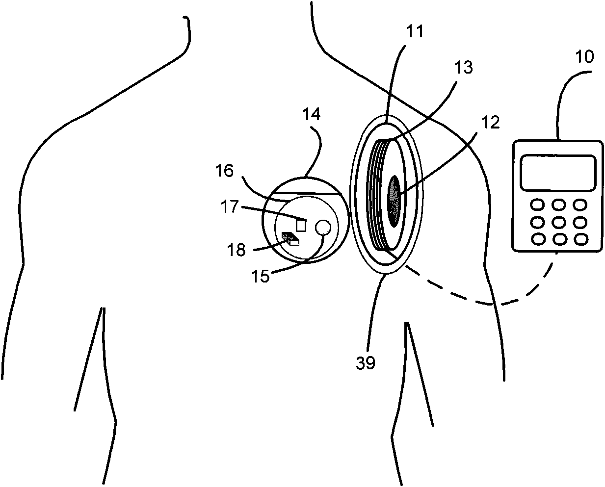 Percutaneous closed-loop control charging device for implantation type medical treatment instrument